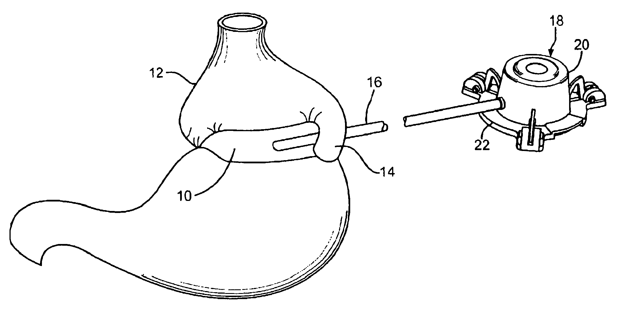 Subcutaneous self attaching injection port with integral moveable retention members