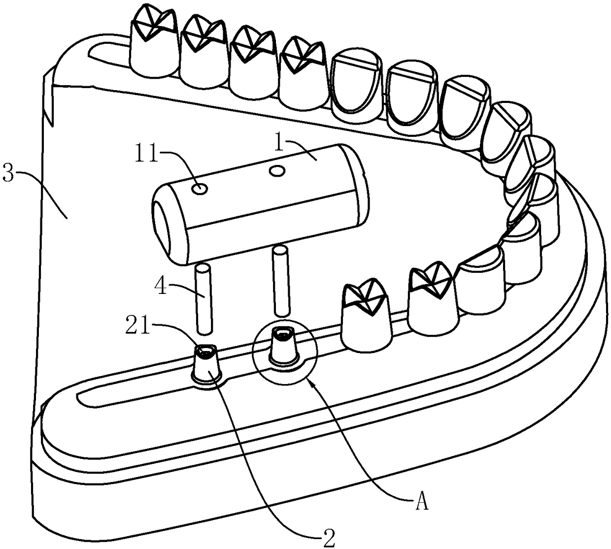 Dental implant implantation method