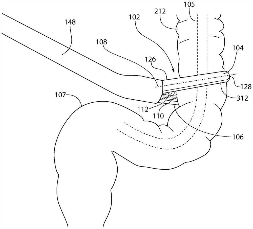 Devices and methods for minimally invasive surgical procedures