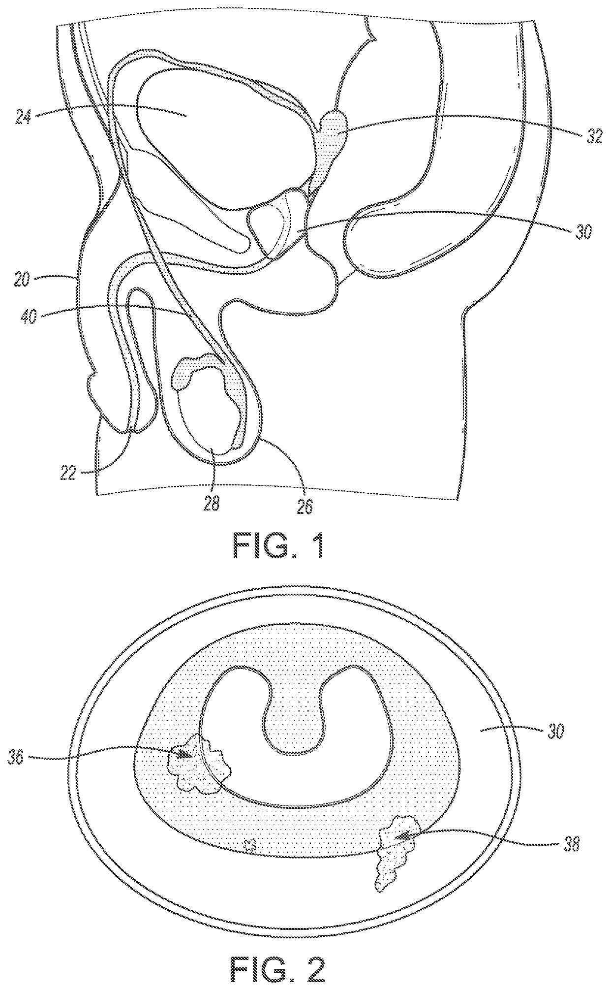 System and method for prostate treatment under local anesthesia