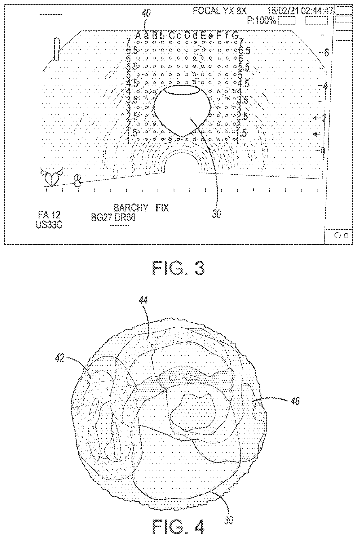 System and method for prostate treatment under local anesthesia