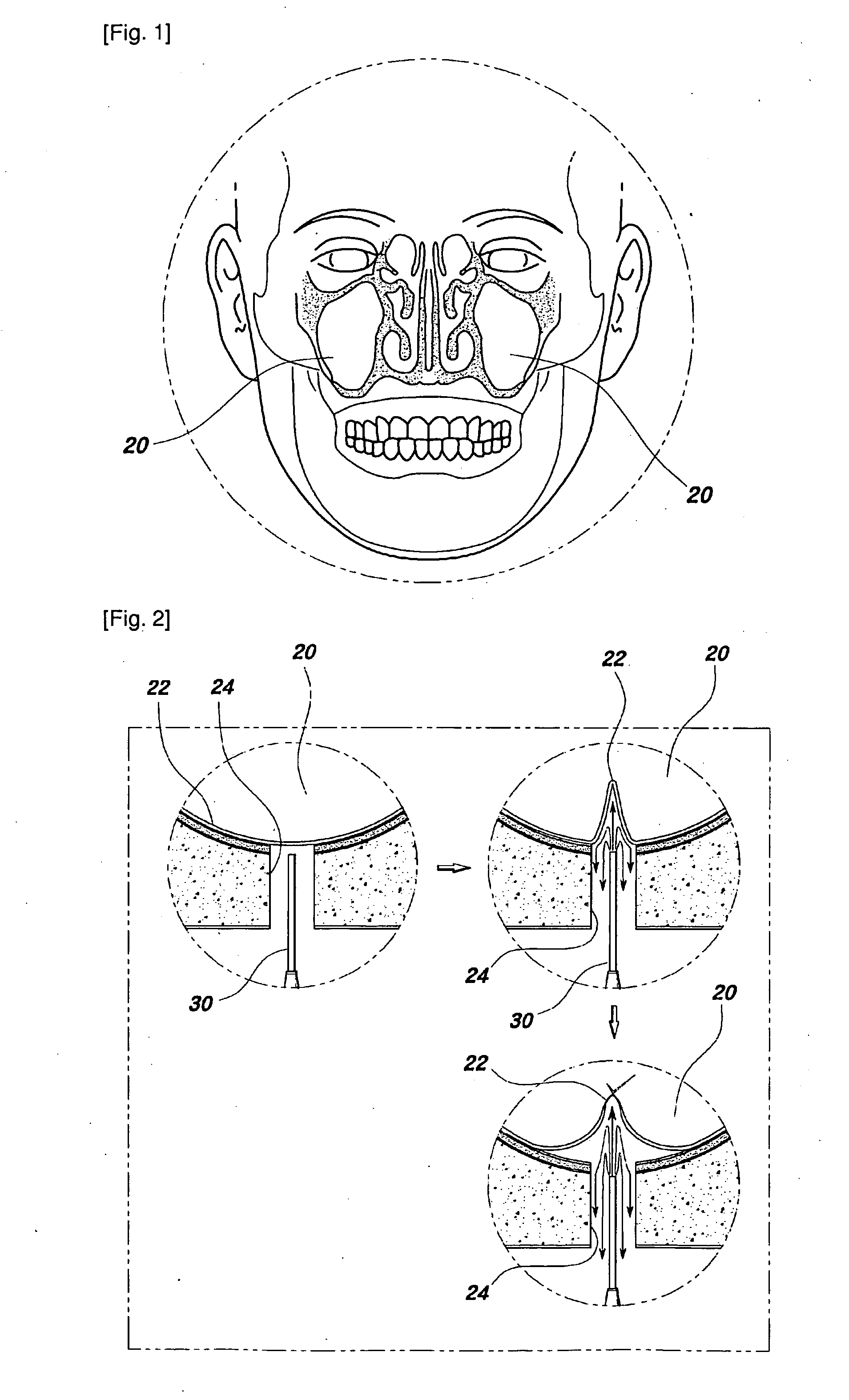 Apparatus of liquid injecting for lifting maxillary sinus mucous membrance and the method for the same utilizing this apparatus