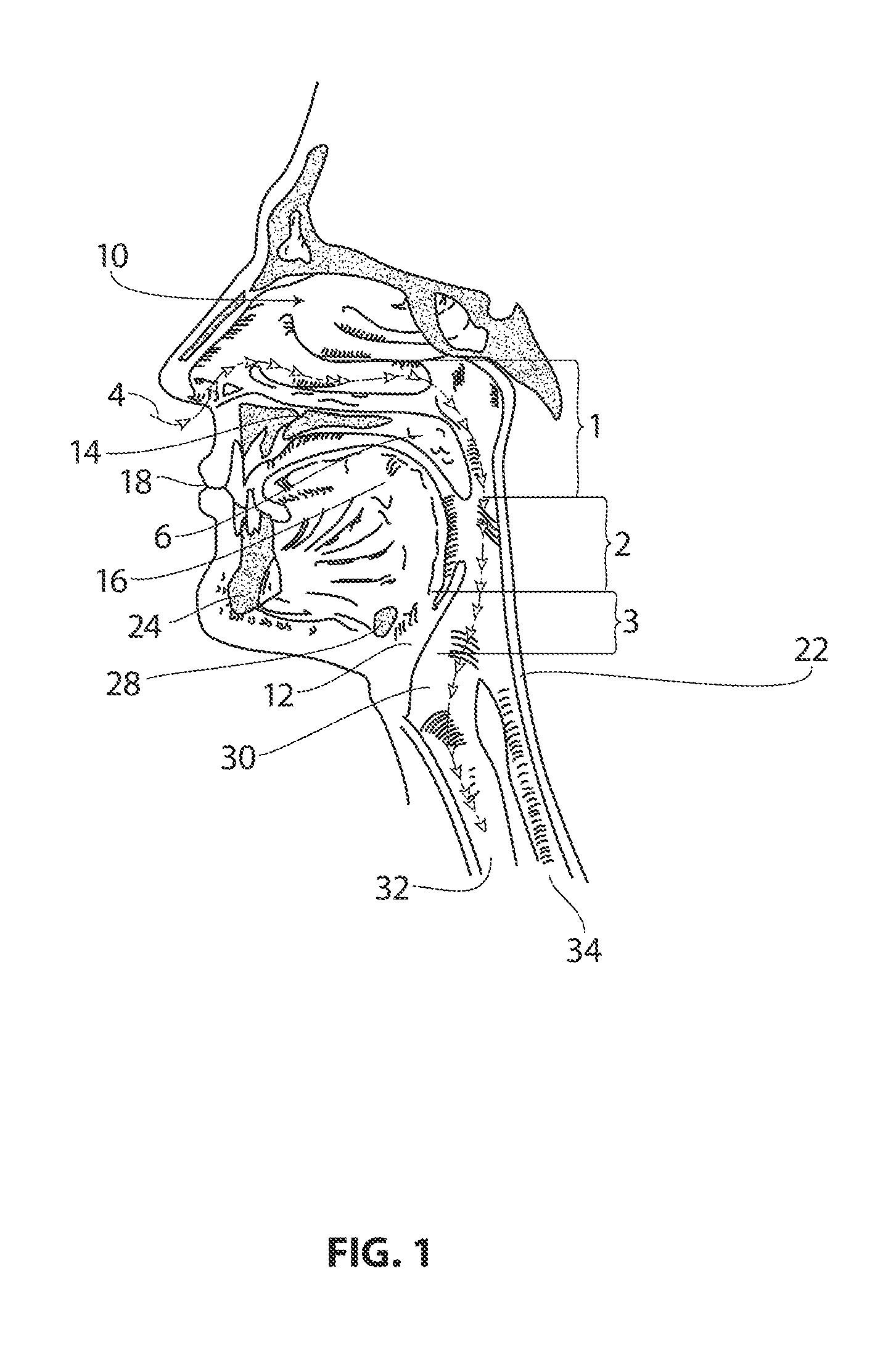 Systems and methods for treatment of sleep apnea