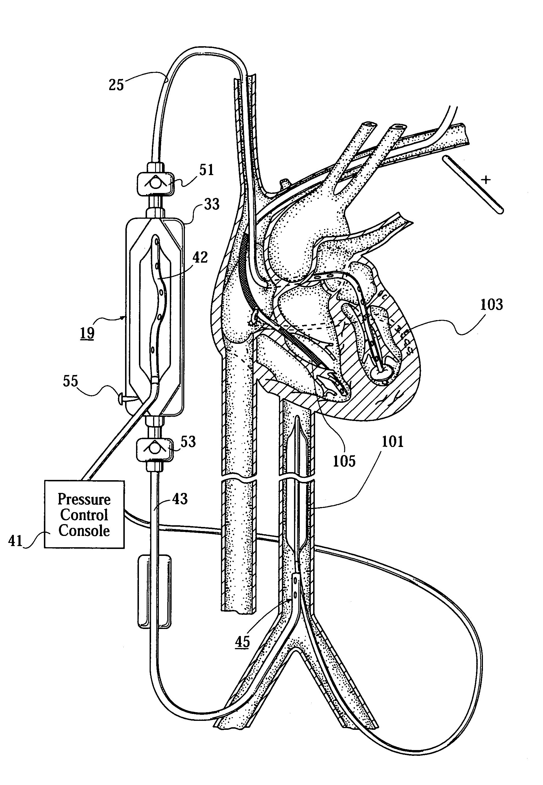 Minimally invasive ventricular assist technology and method