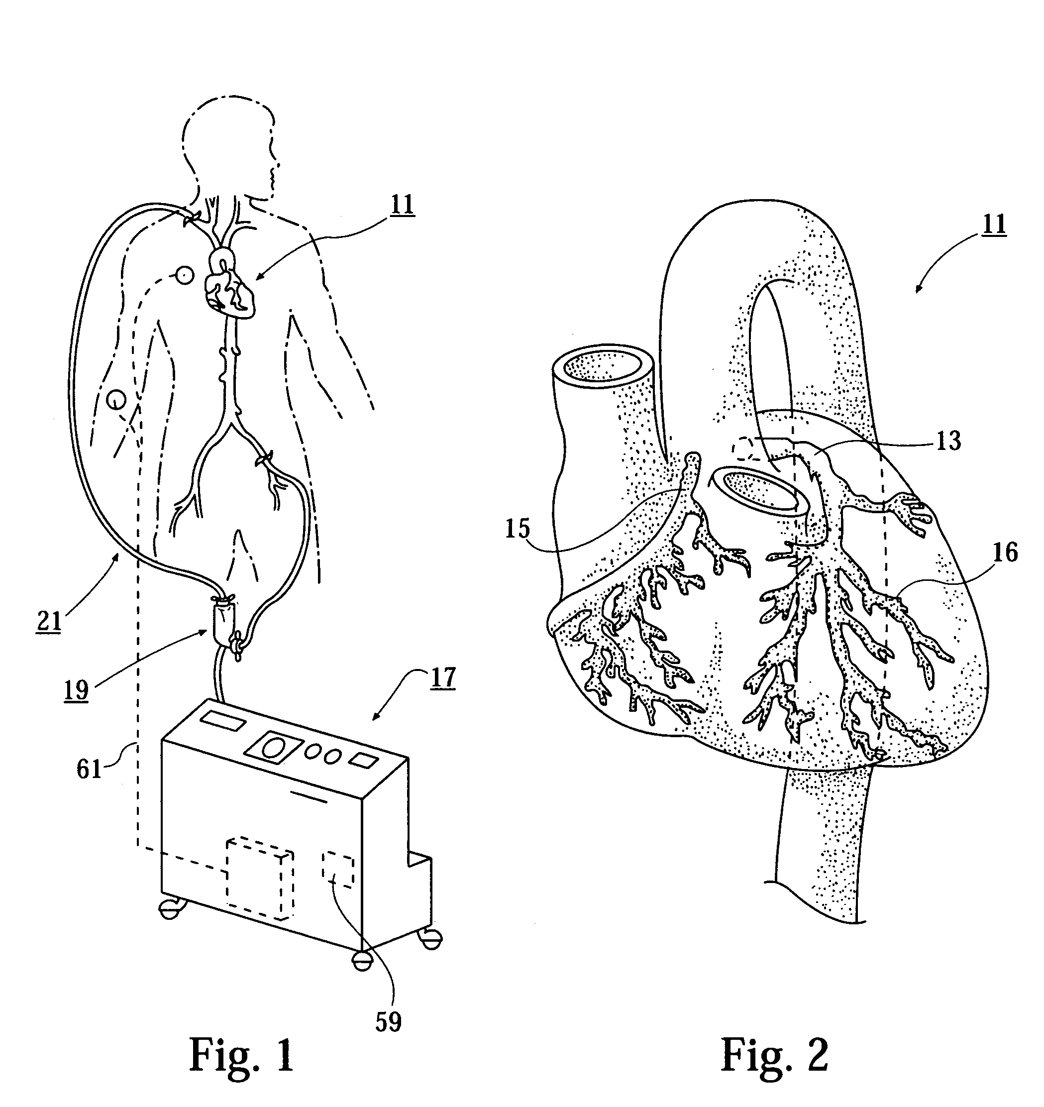 Minimally invasive ventricular assist technology and method
