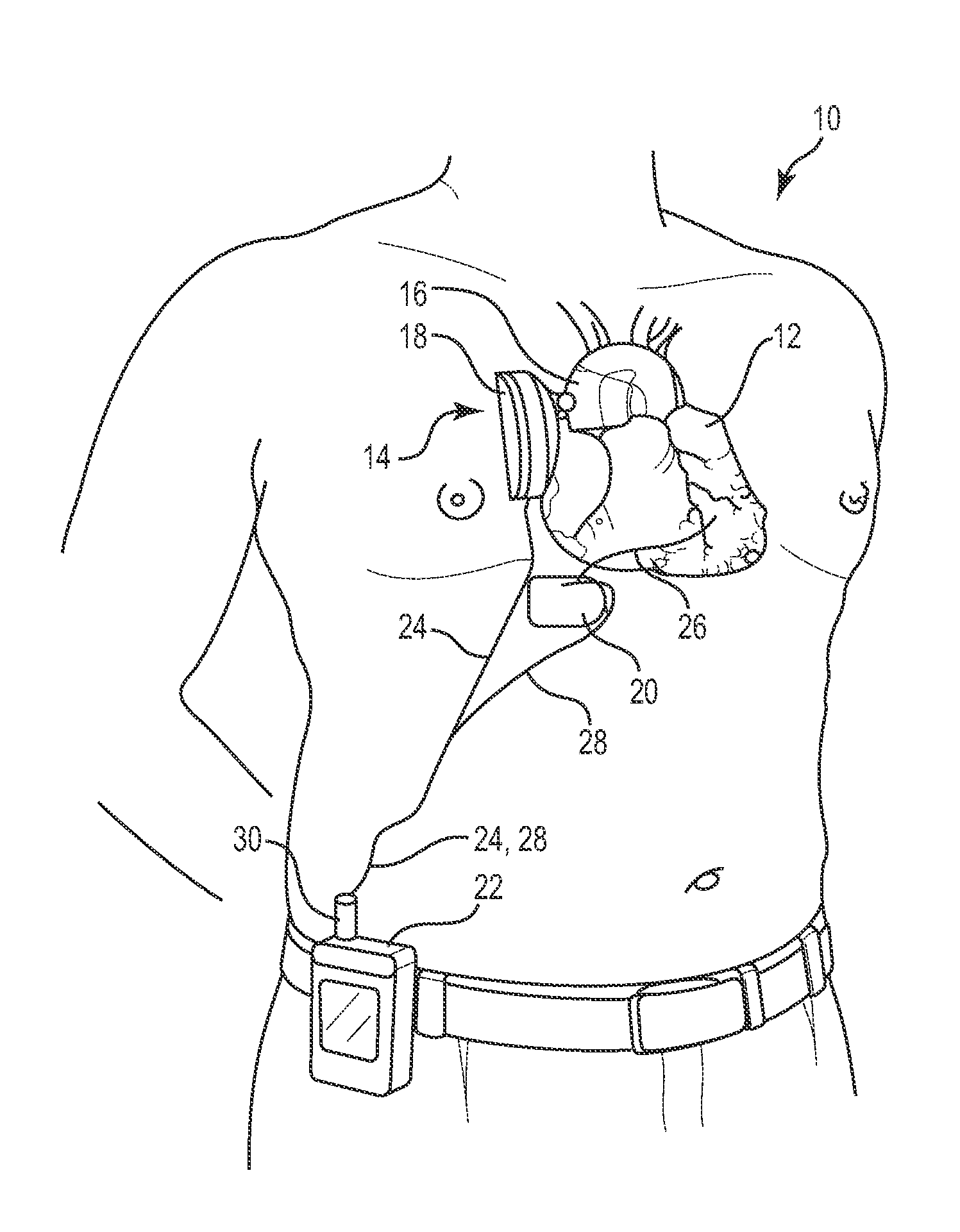 Combination Heart Assist Systems, Methods, and Devices