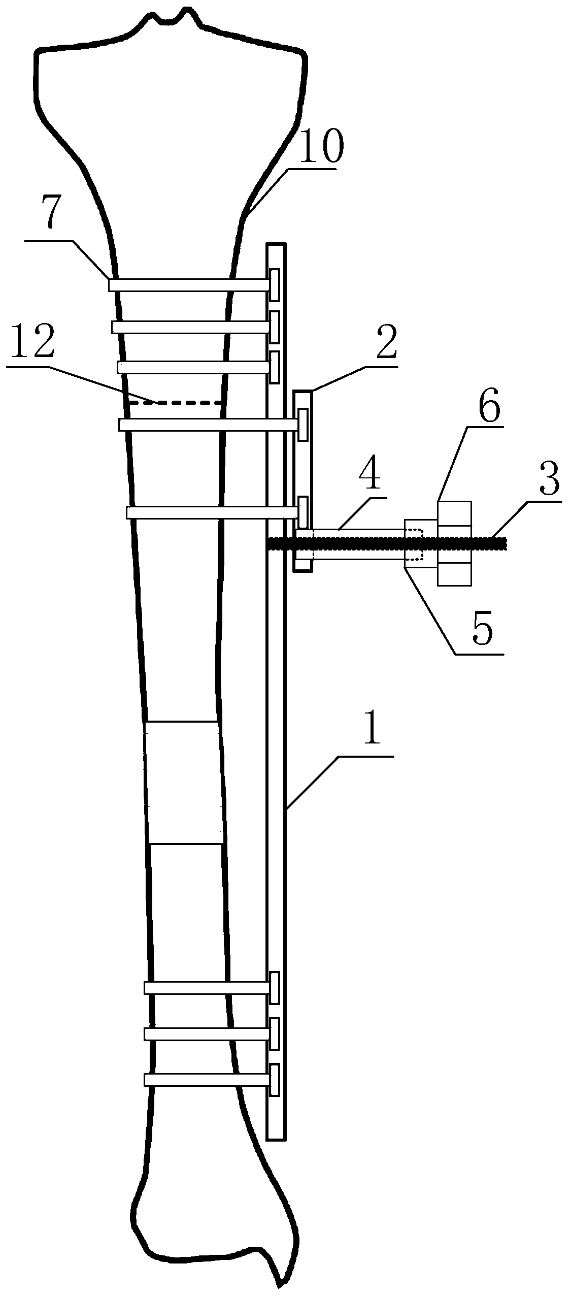 Relay type bone moving device based on gear power and use method of device