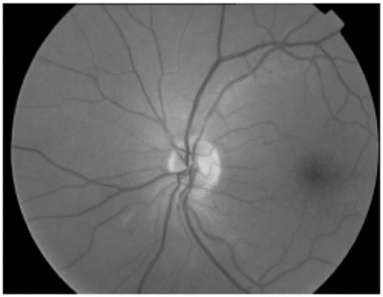 Classifier for micro-angioma of diabetes lesion based on colored image