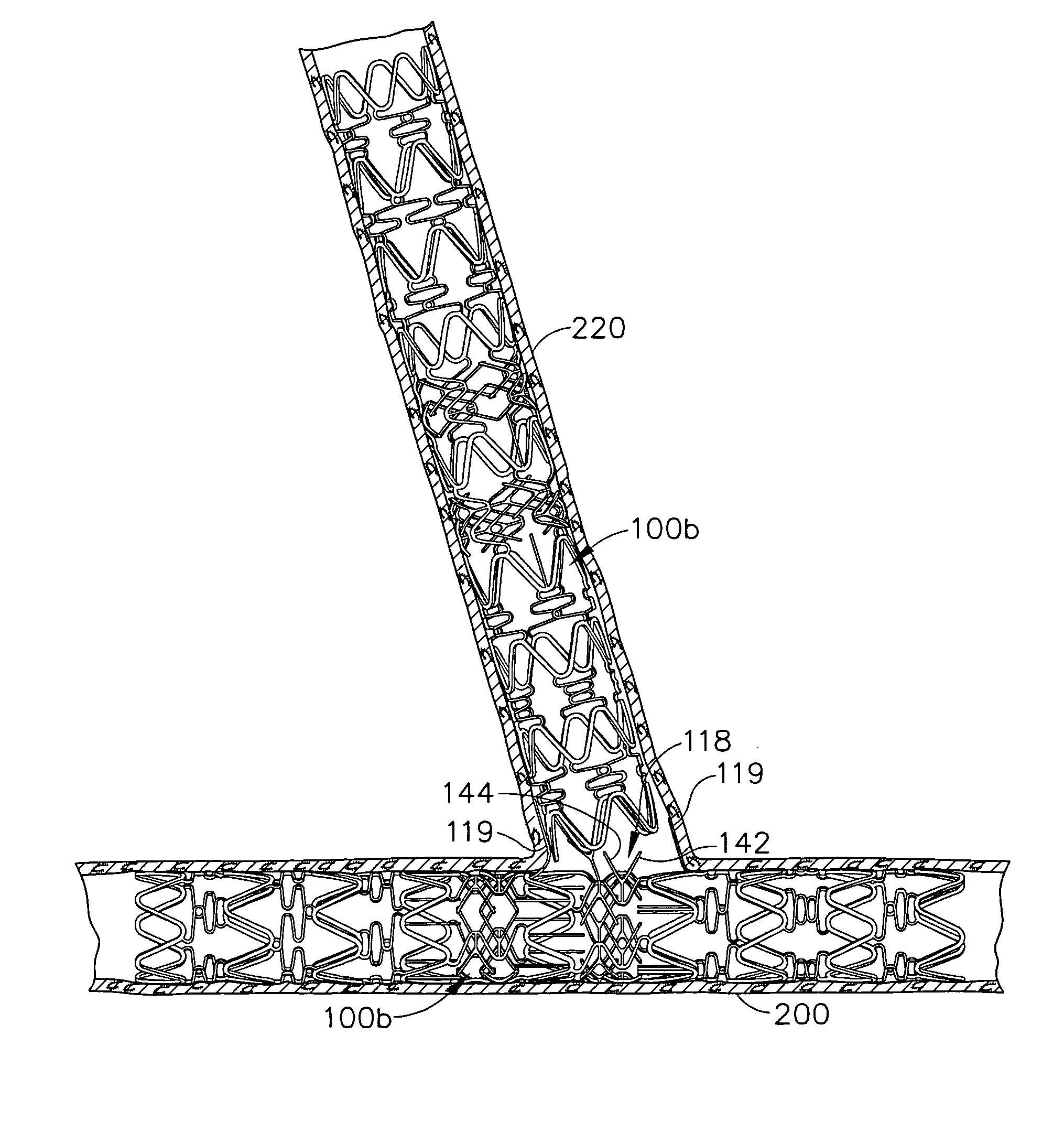 Method for treating a bifurcated vessel