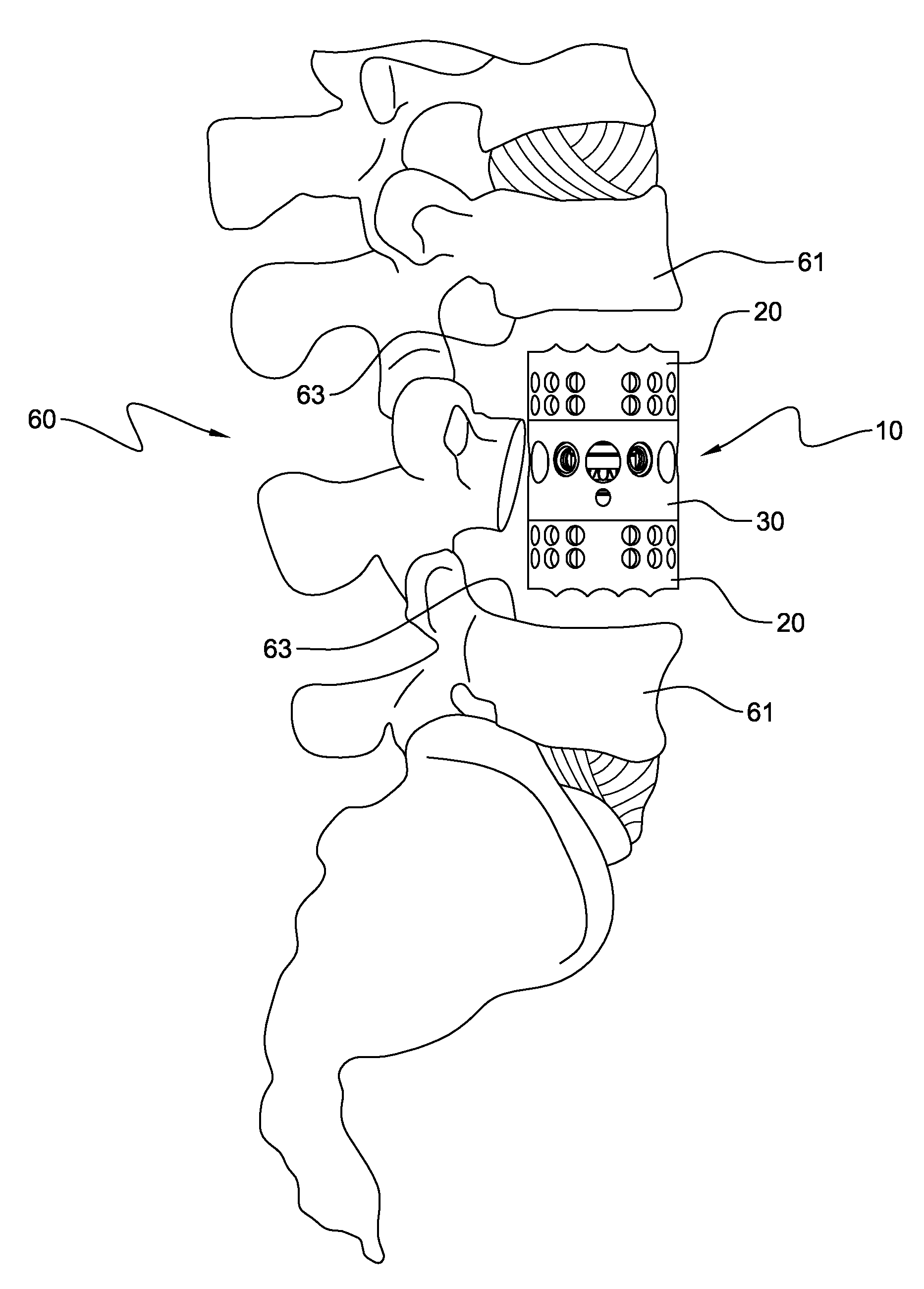 Footplate member and a method for use in a vertebral body replacement device