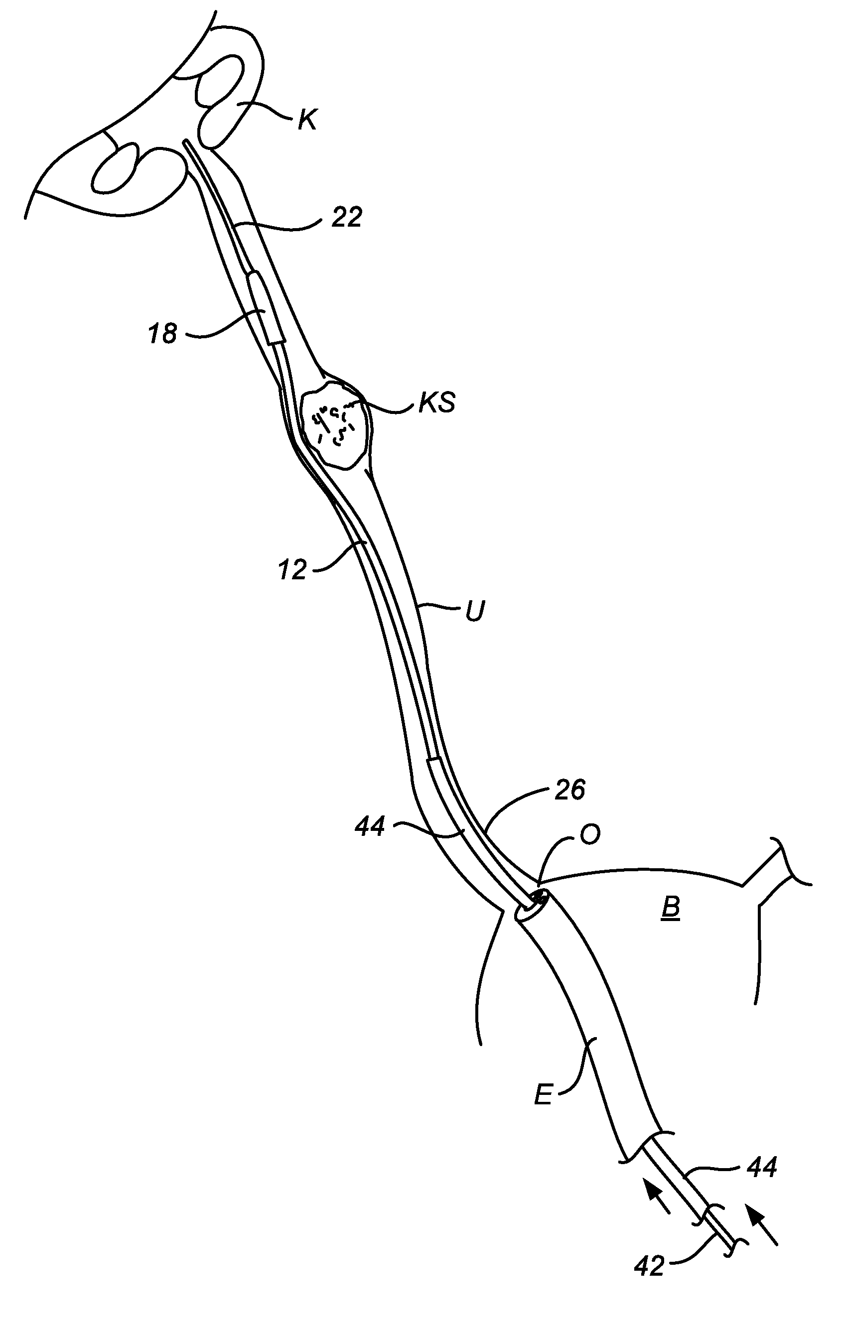 Ureteral stent and method and system for its deployment