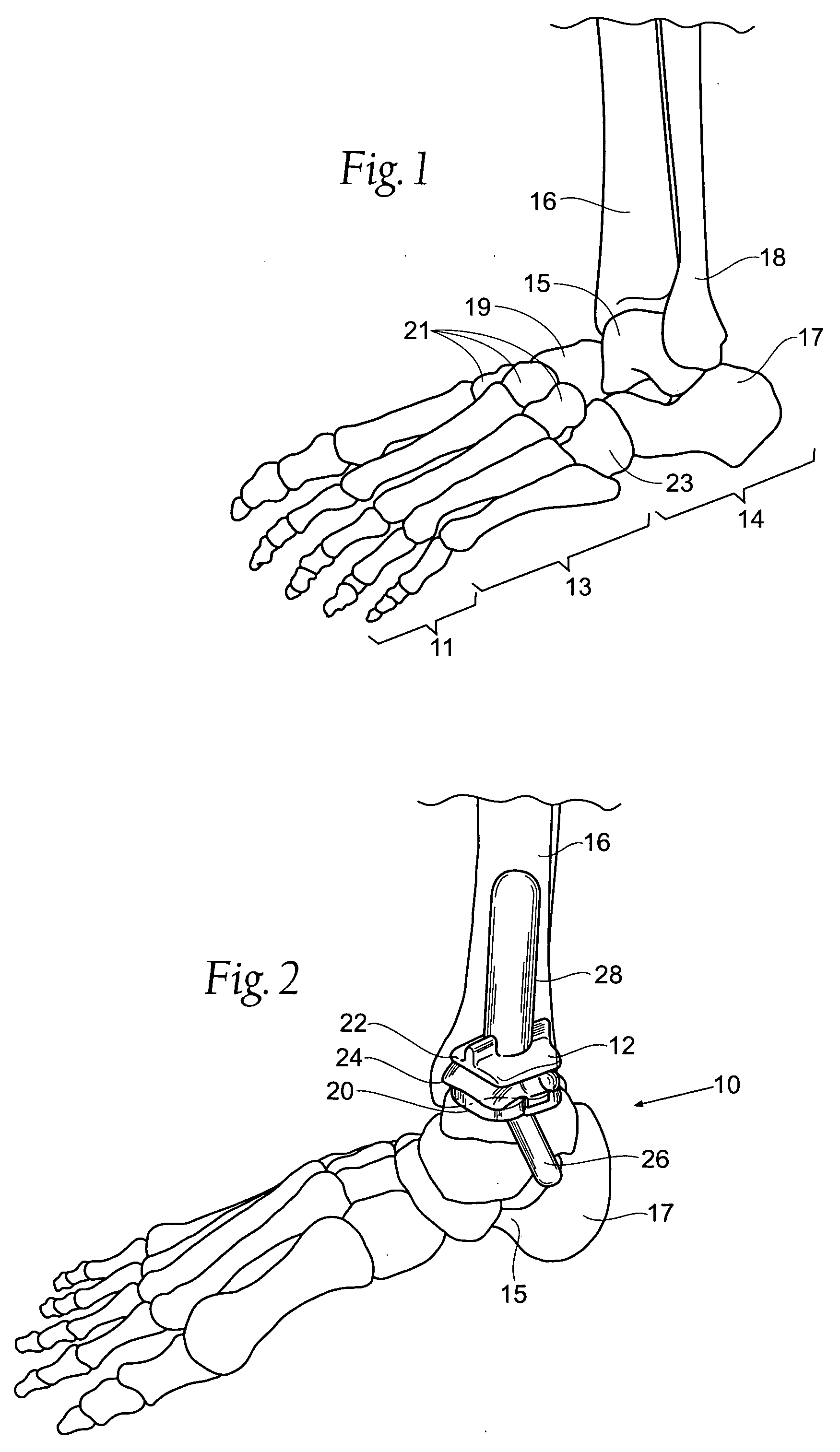Ankle replacement system