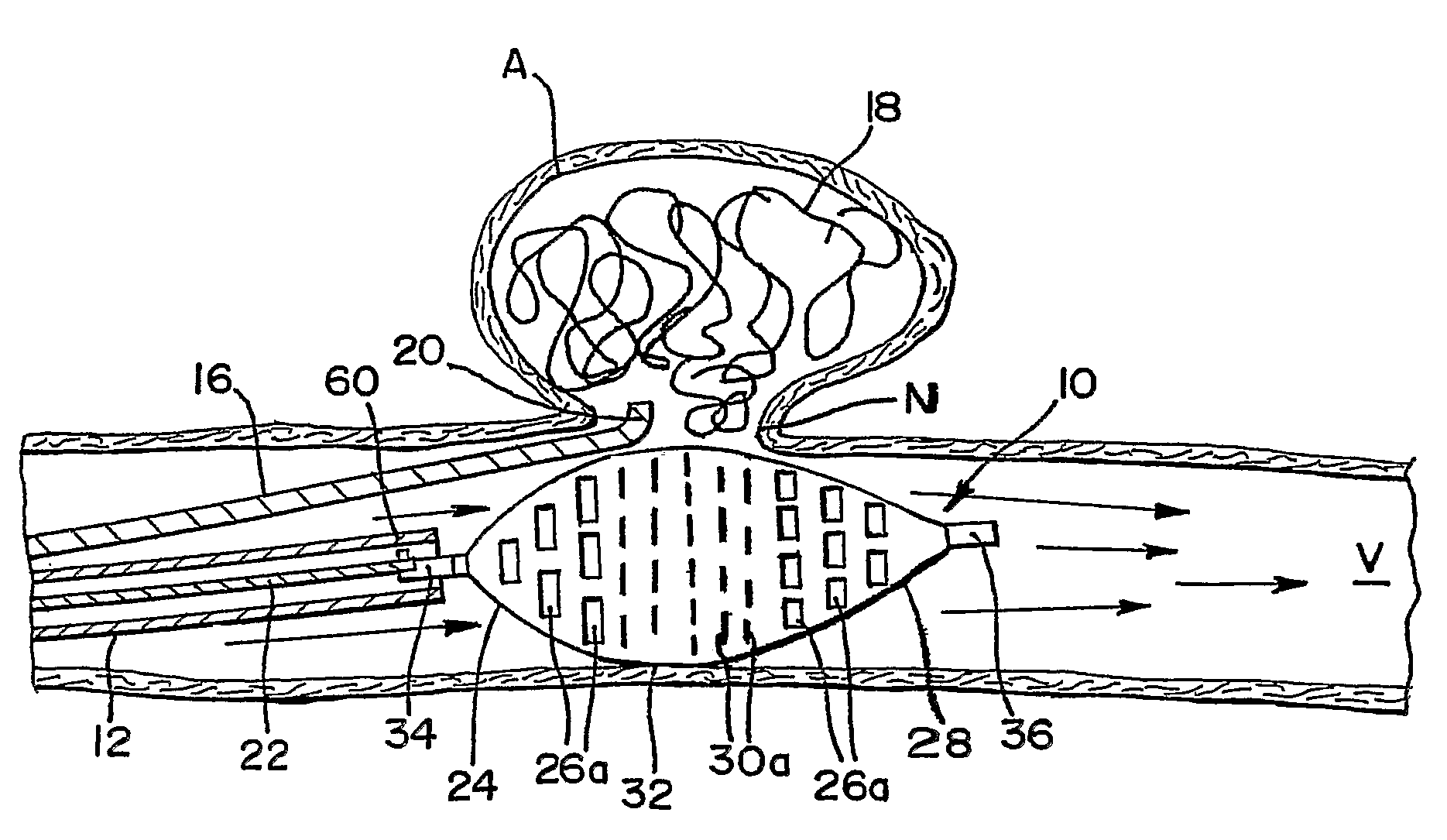 Remodeling device for aneurysms