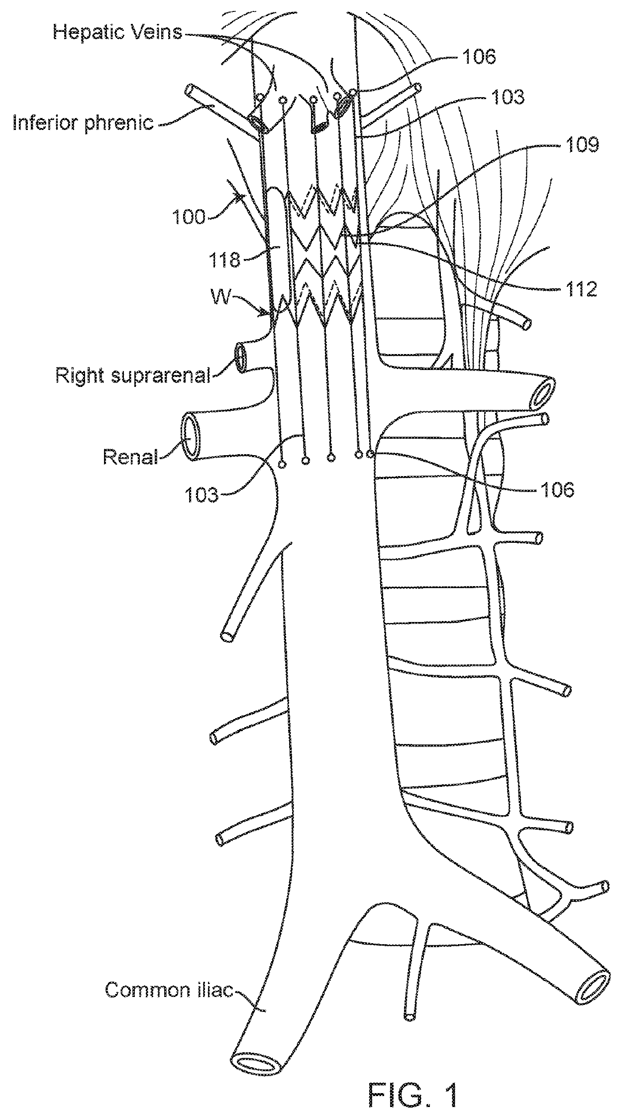 Implantable Devices and Related Methods for Heart Failure Monitoring