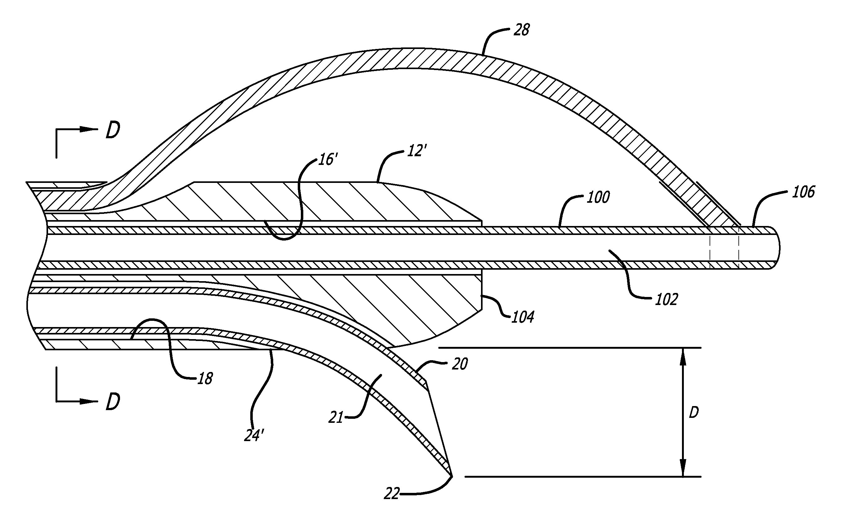 Needle catheter for delivery of agents directly into vessel wall