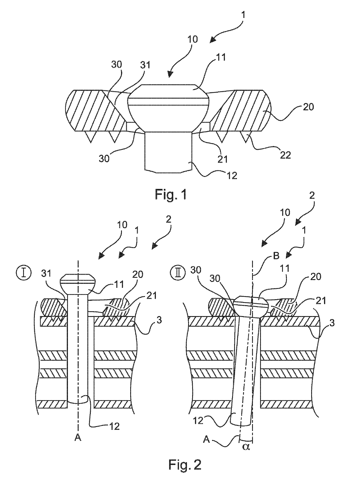 Bone screw system