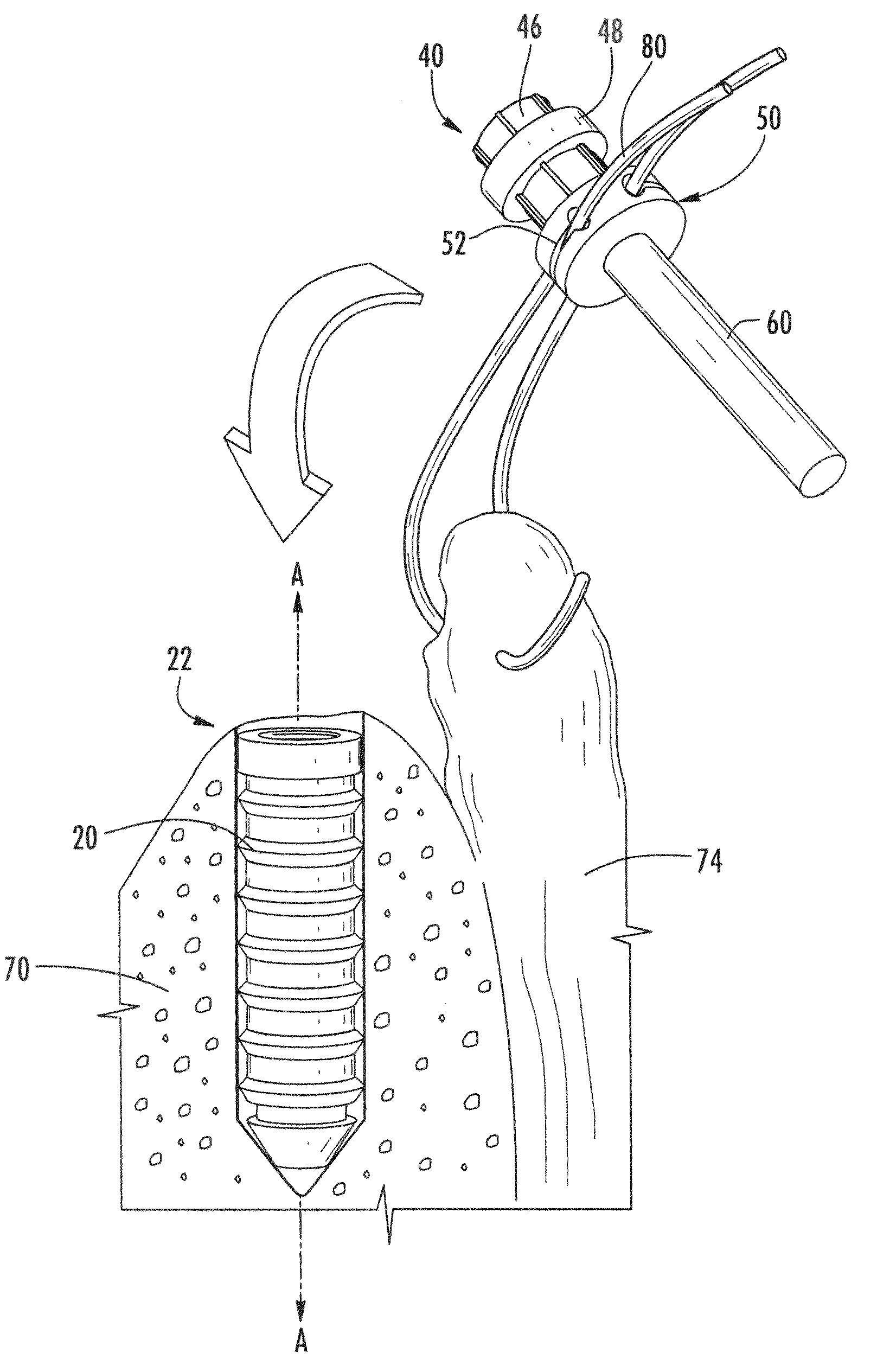 Soft tissue fixation assembly and method