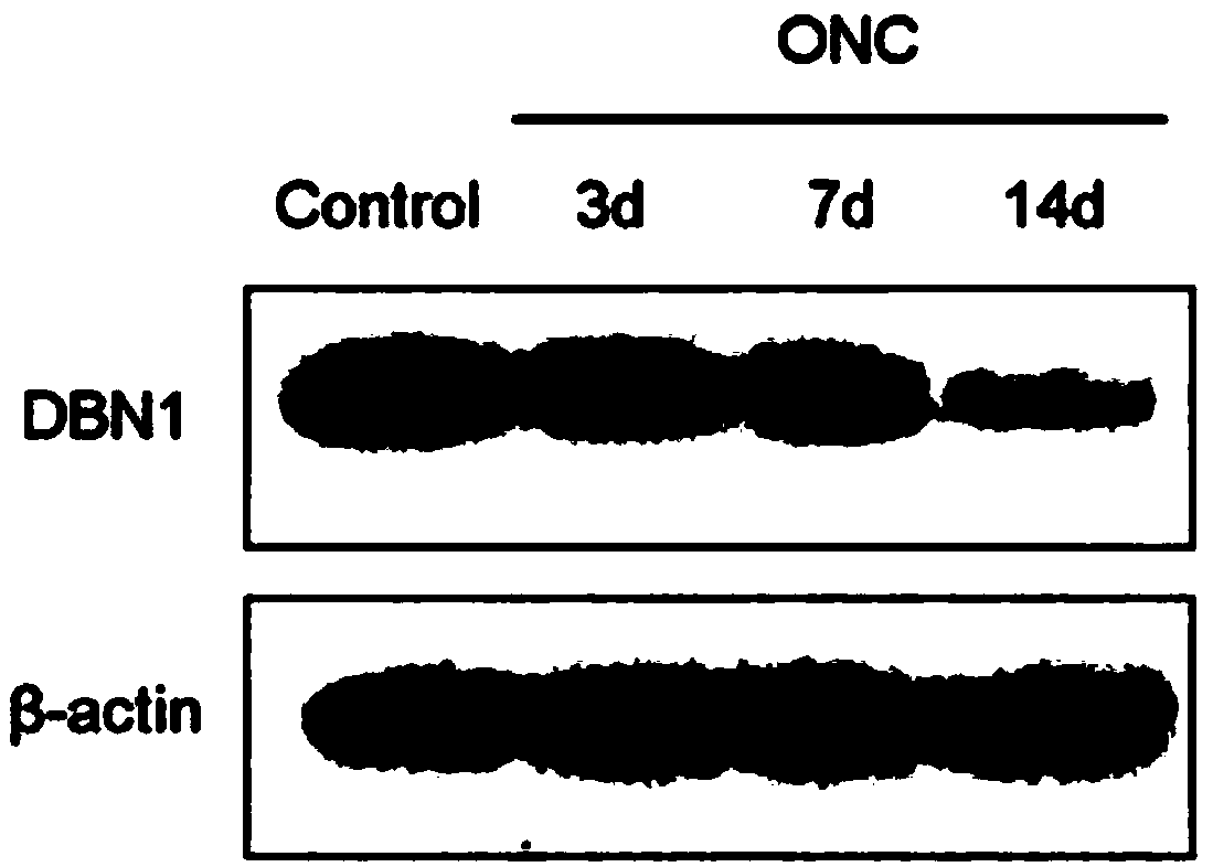 Application of drebrin (DBN1) to preparing neurodegenerative disease diagnosis medicines