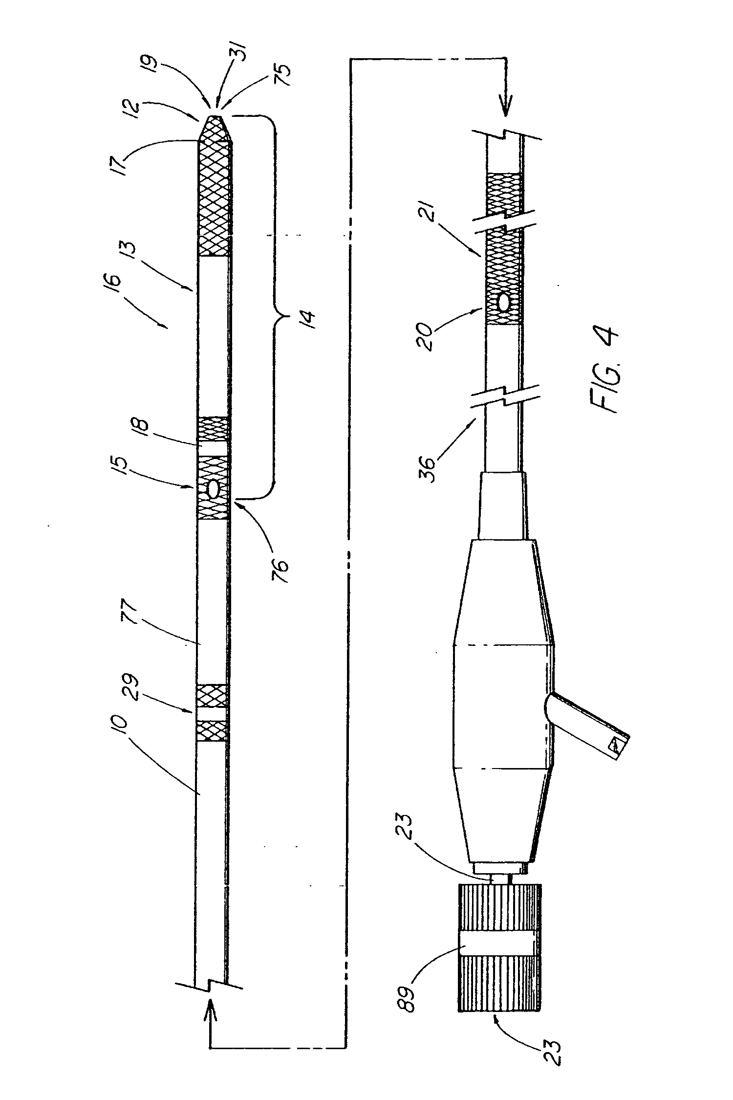 System and method for introducing a prosthesis