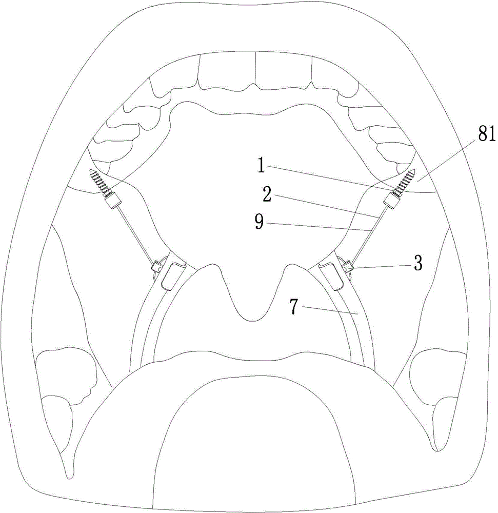 Lateral pharyngeal wall traction device and implantation method