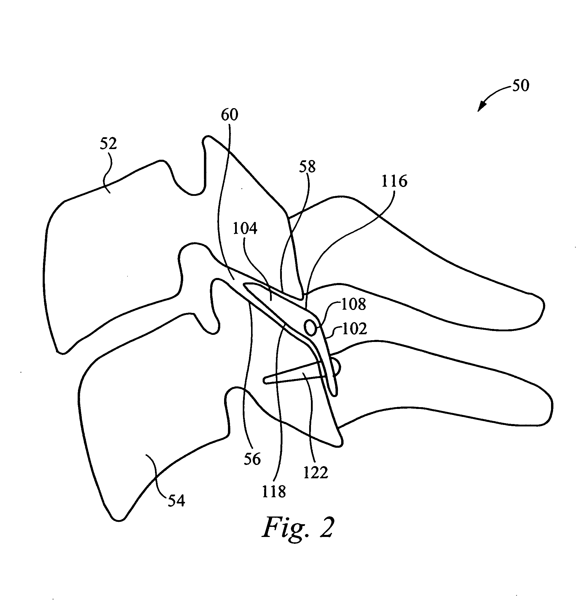 Inter-cervical facet implant distraction tool