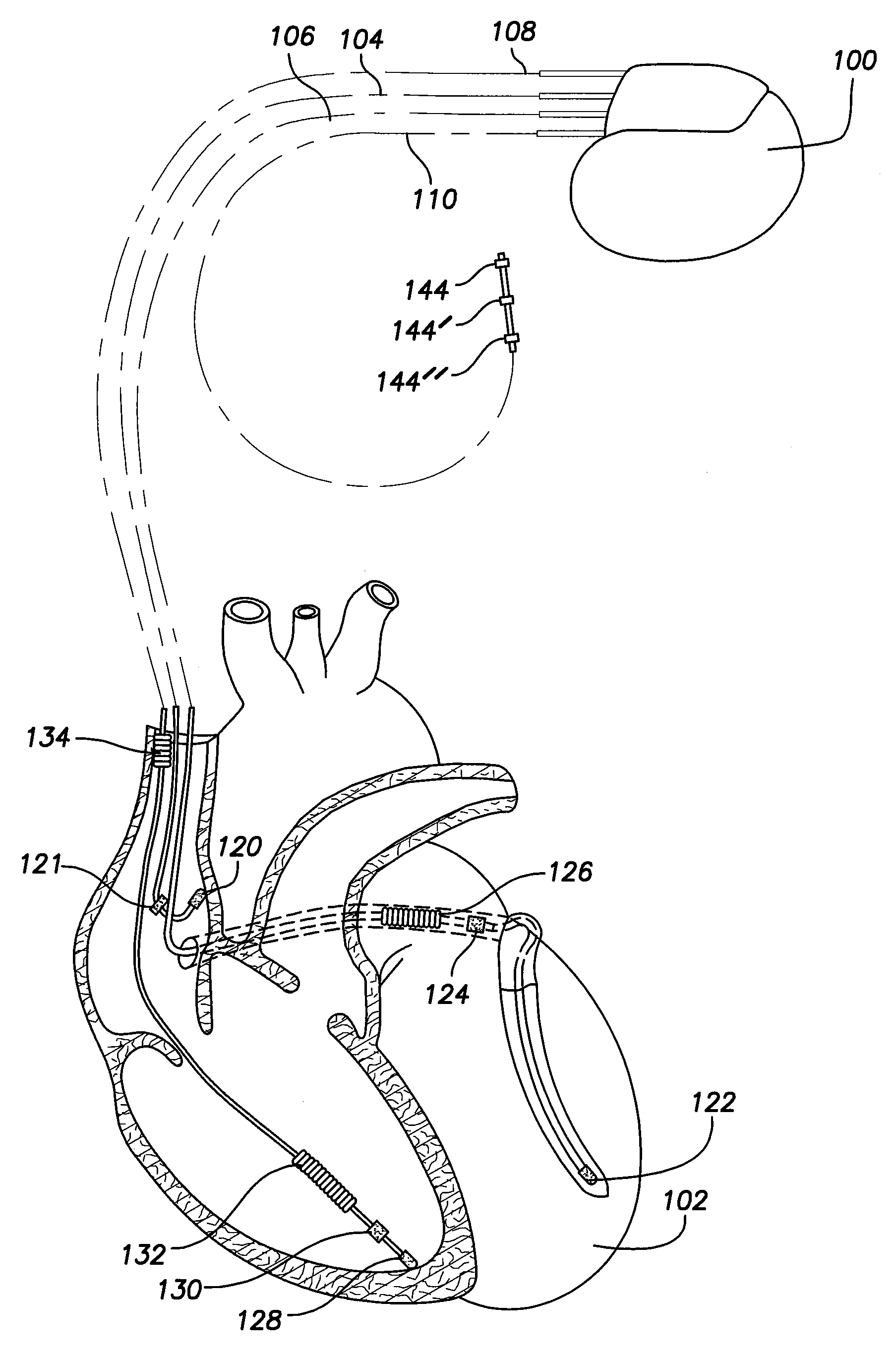 Systems and Methods for Controlling Ventricular Pacing in Patients with Long Inter-Atrial Conduction Delays