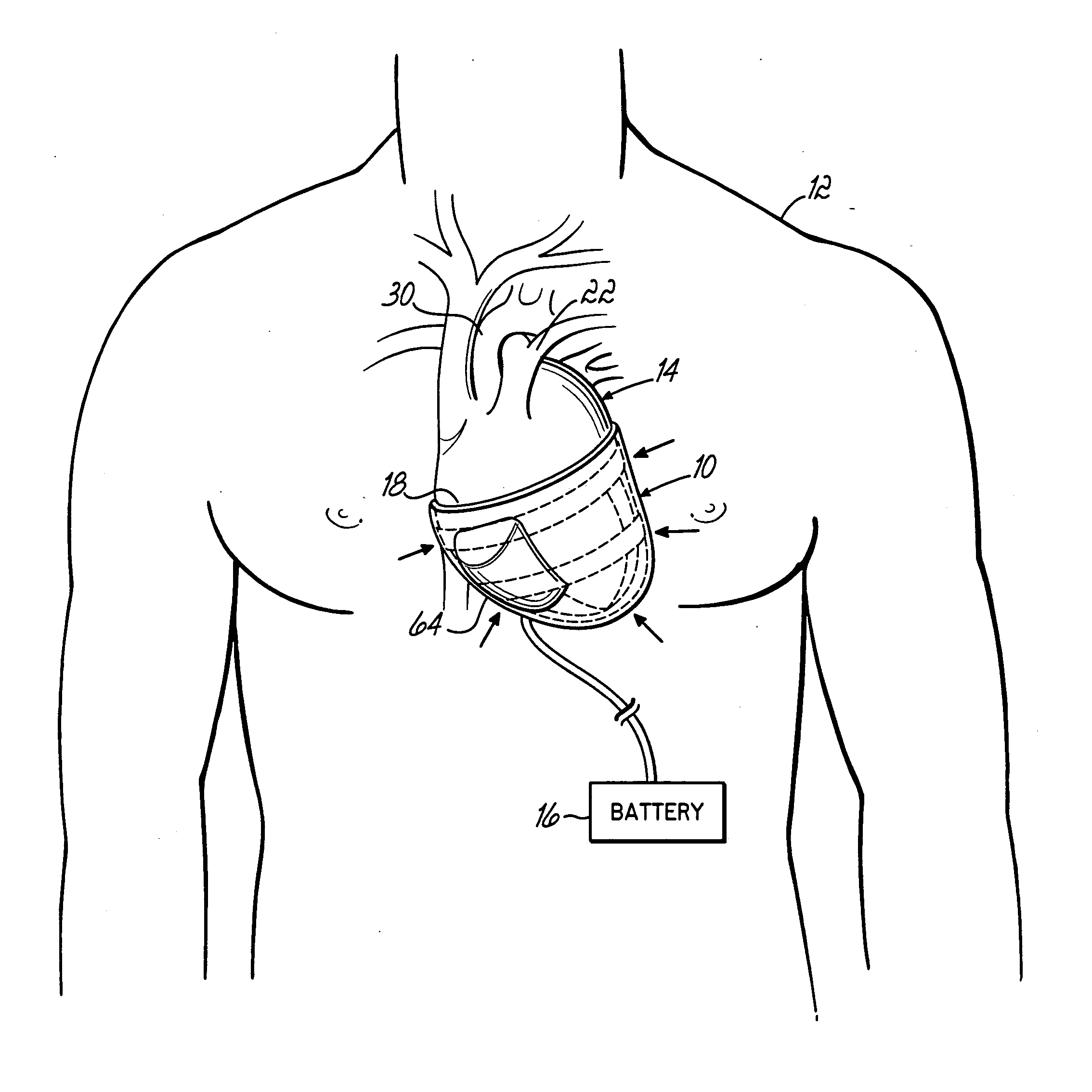 Implantable heart assist devices and methods