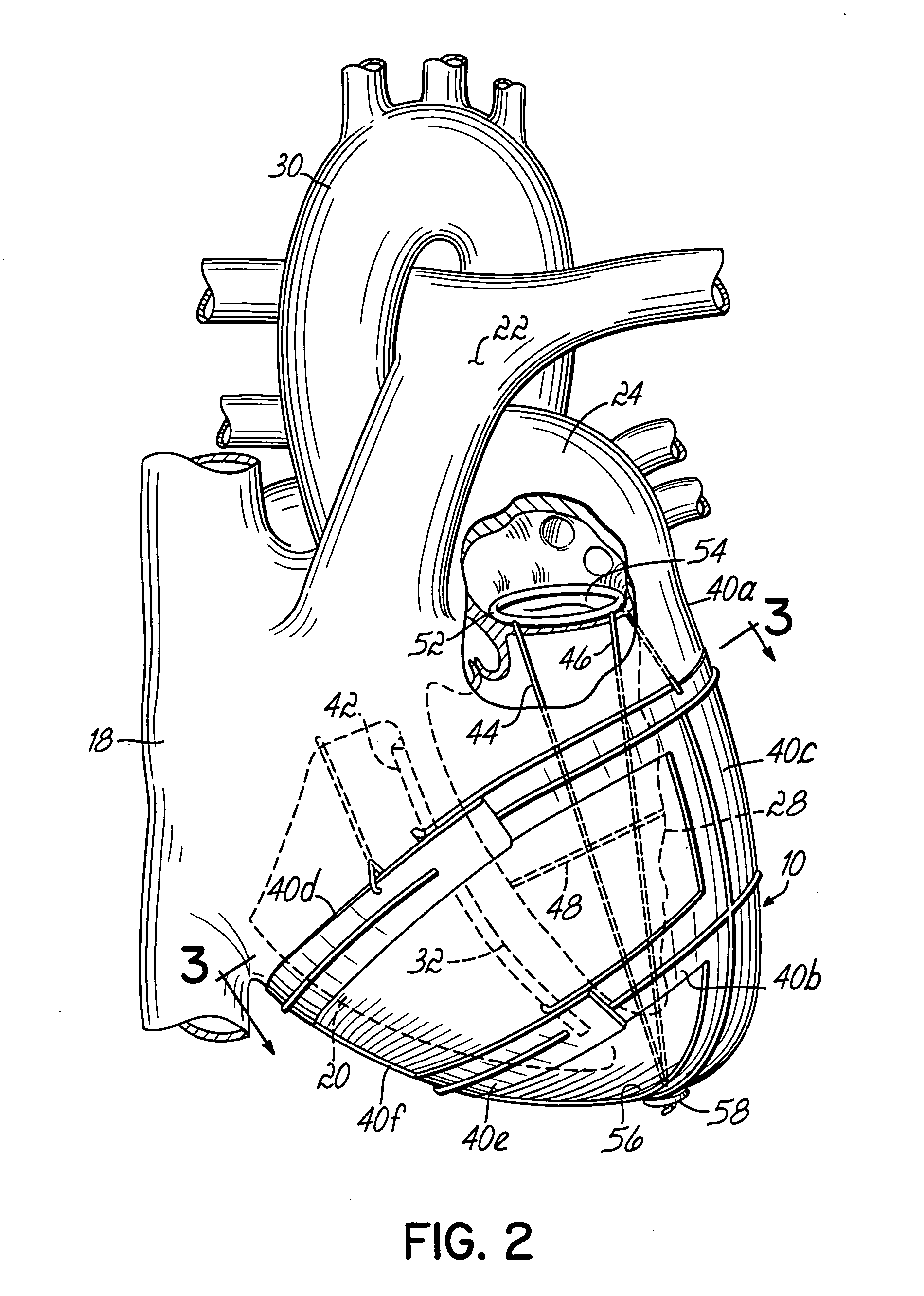 Implantable heart assist devices and methods
