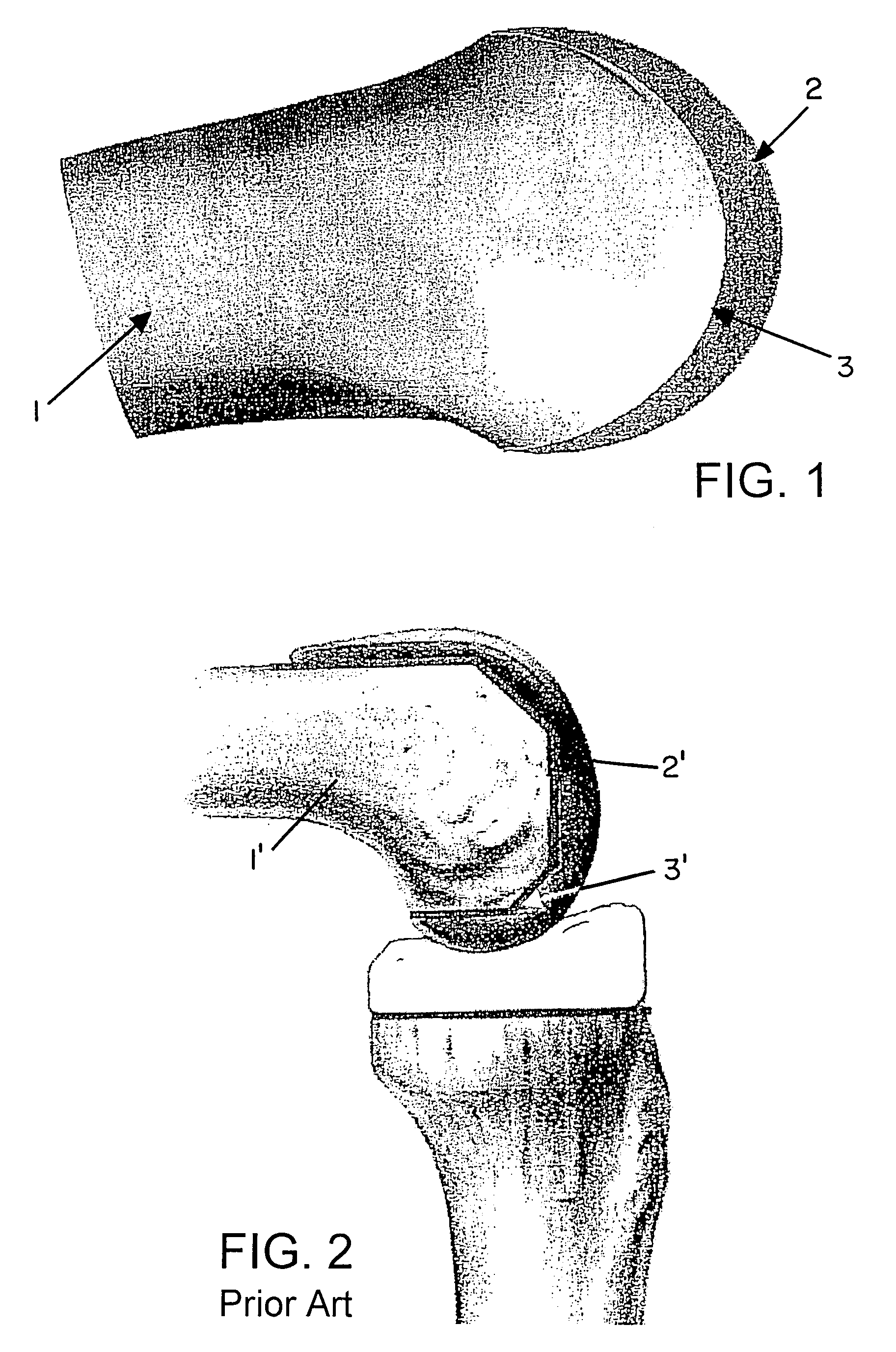 Planning method and system for free-form implant modification
