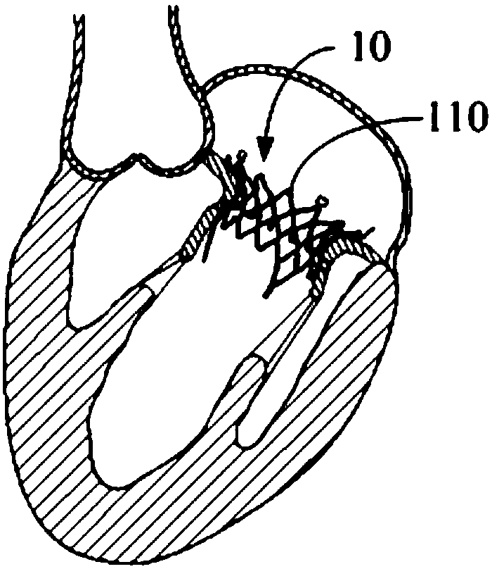 Cardiac valve prosthesis and bracket thereof