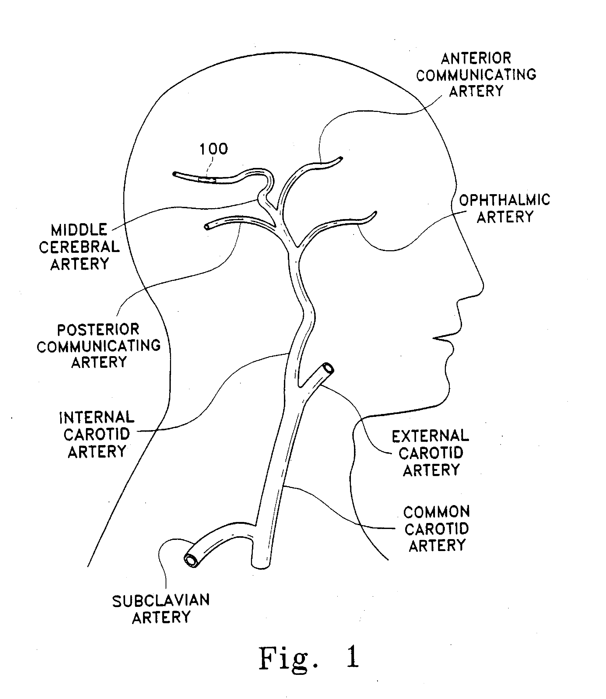 Medical clot treatment device with distal filter