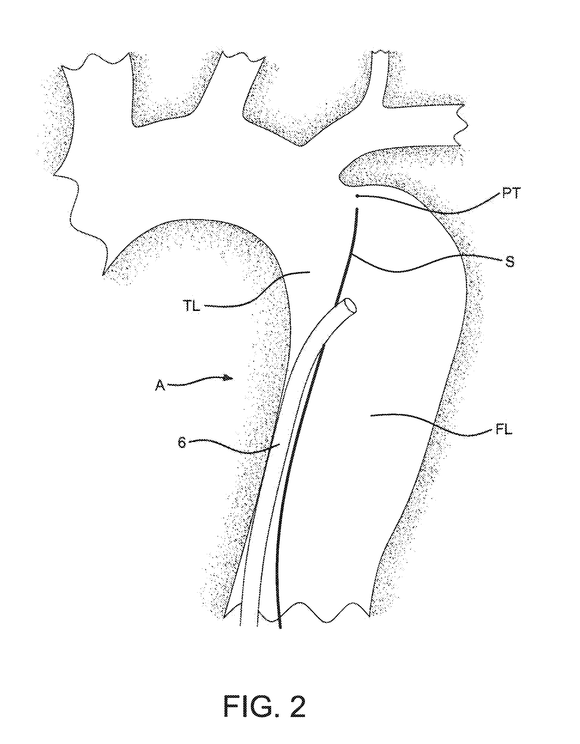 Method of using an aortic dissection septal cutting tool