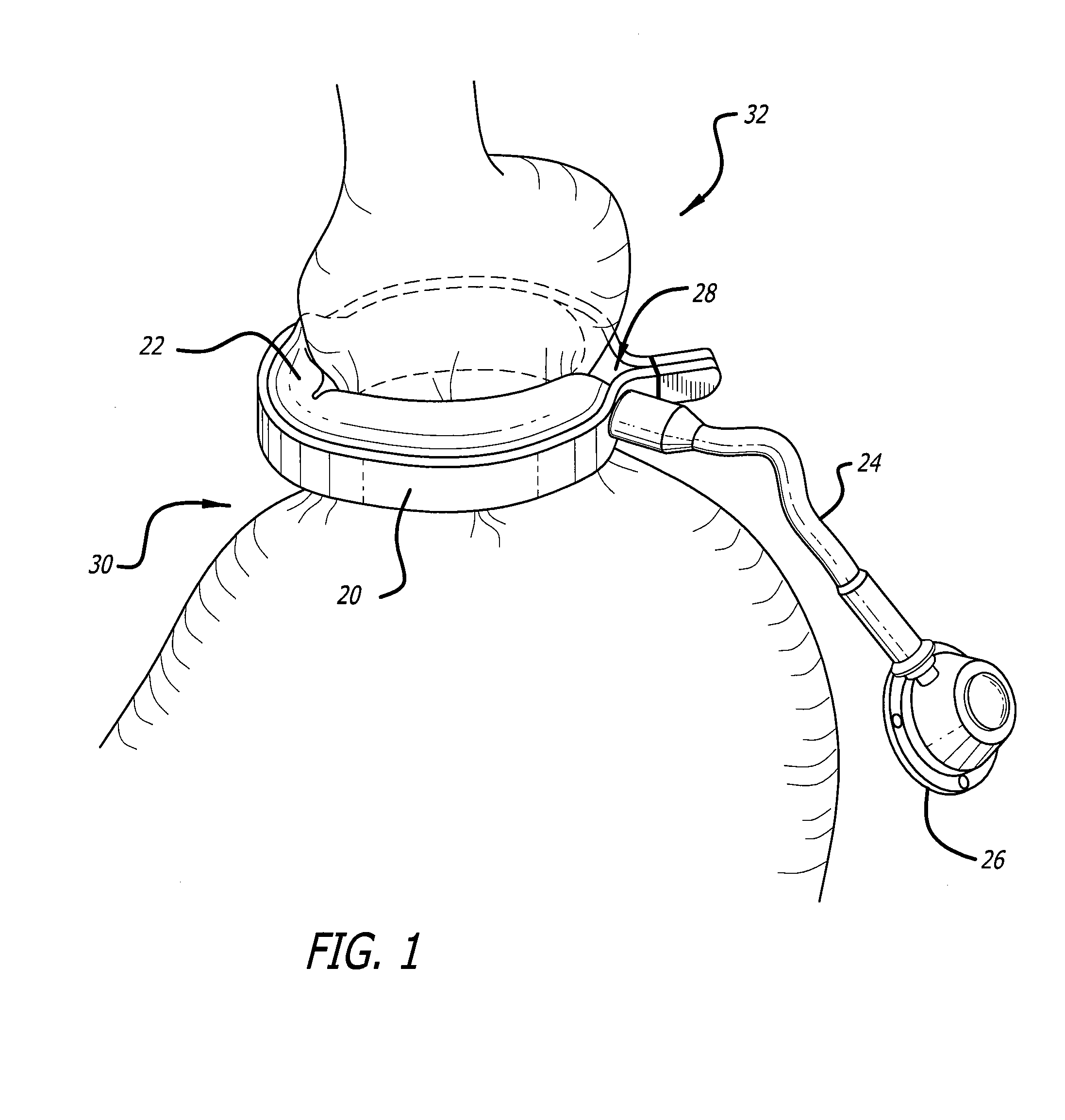 Assembly and method for automatically controlling pressure for a gastric band