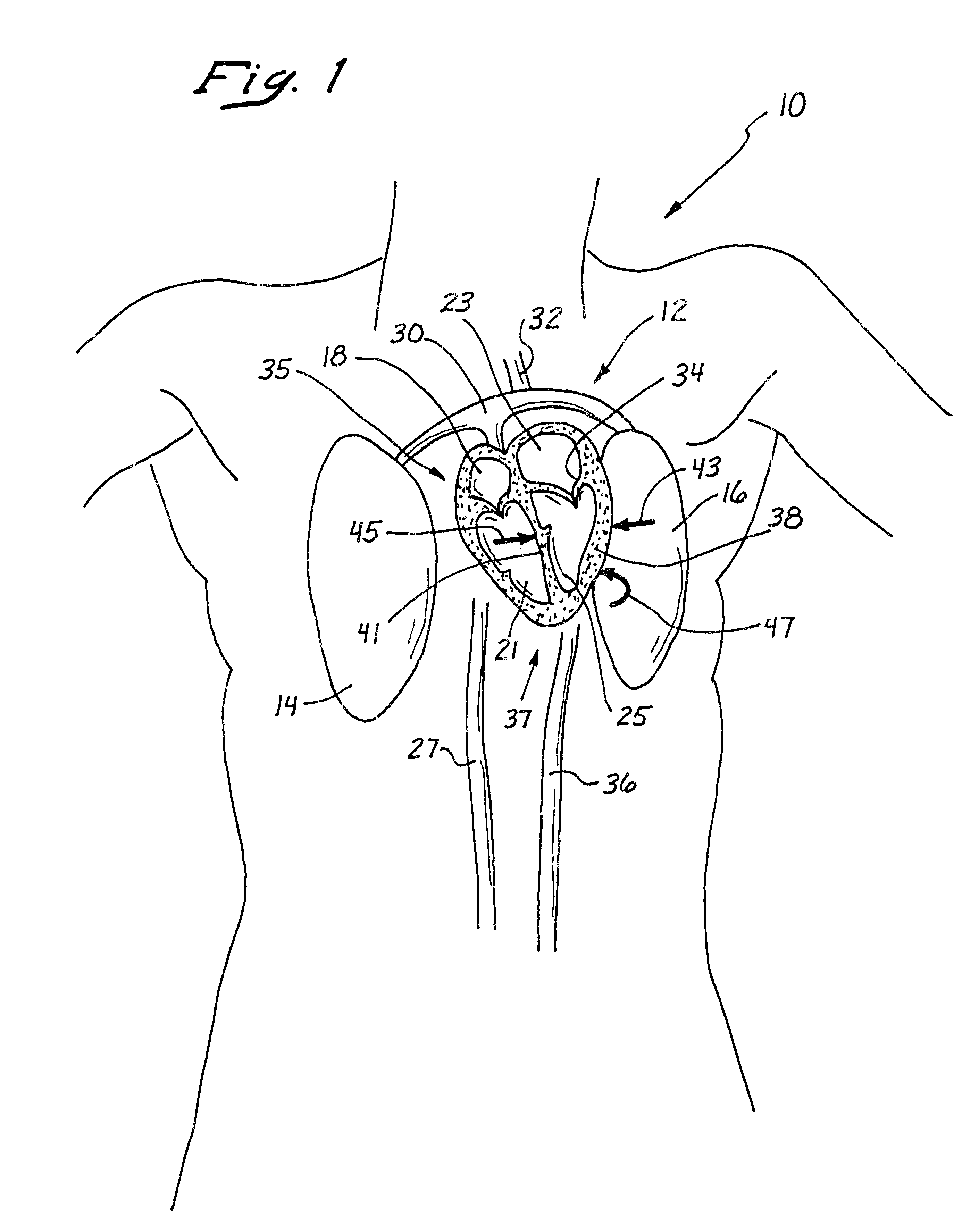 Anterior segment coronary restoration apparatus and method