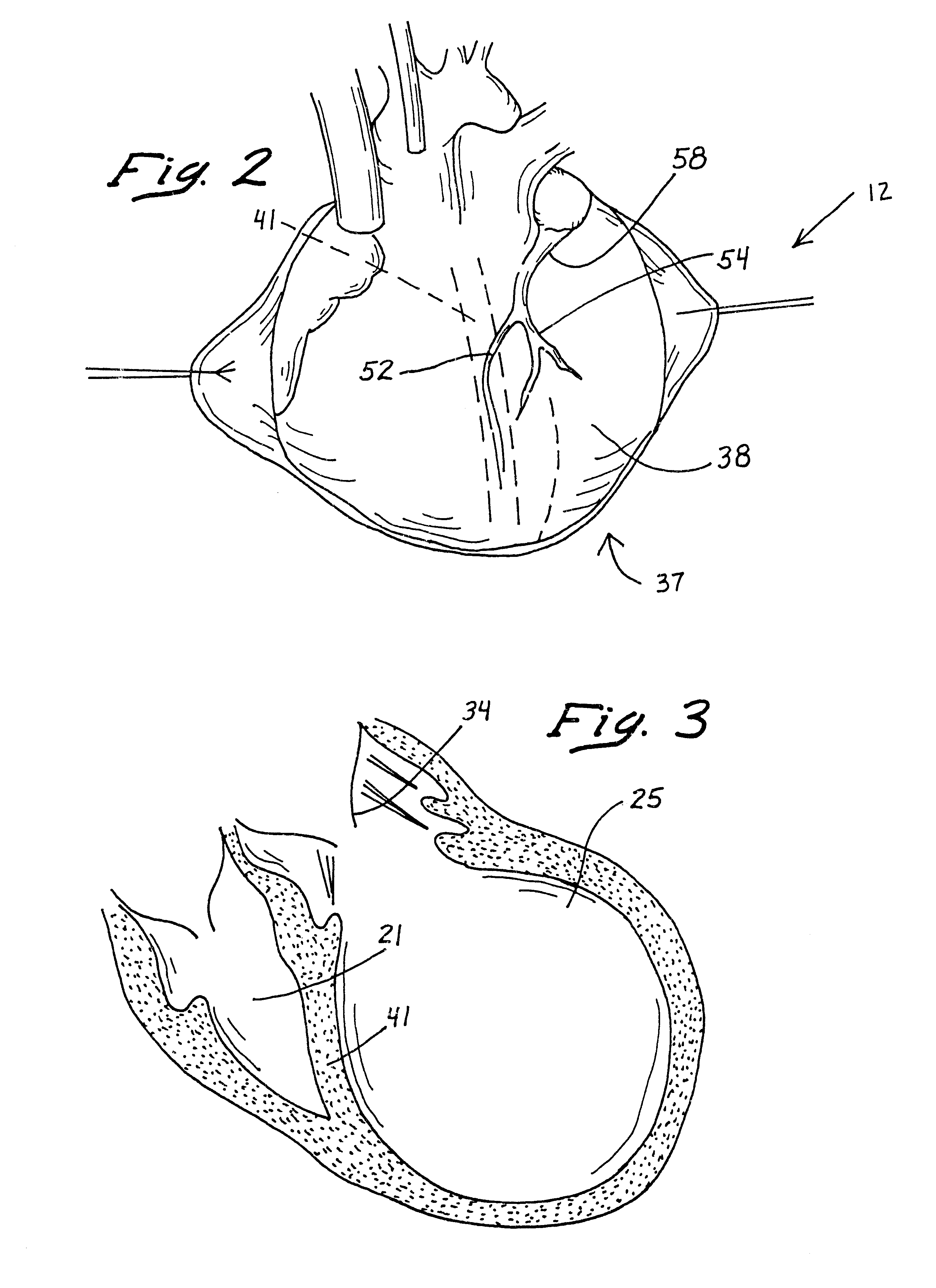 Anterior segment coronary restoration apparatus and method