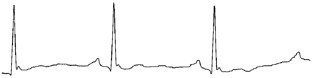 Electrocardiogram feature extraction method, device, system, equipment and classification method based on deep learning algorithm