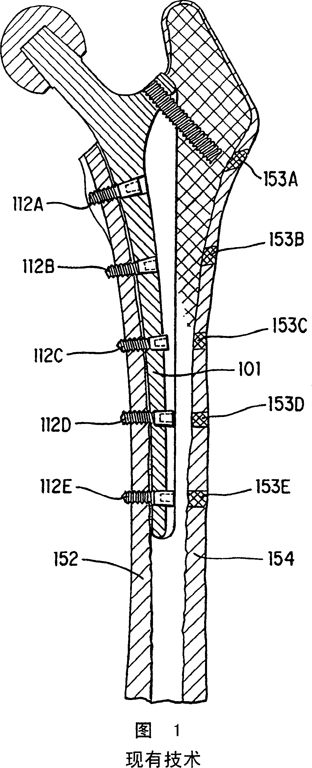 Screw anchored joint prosthesis