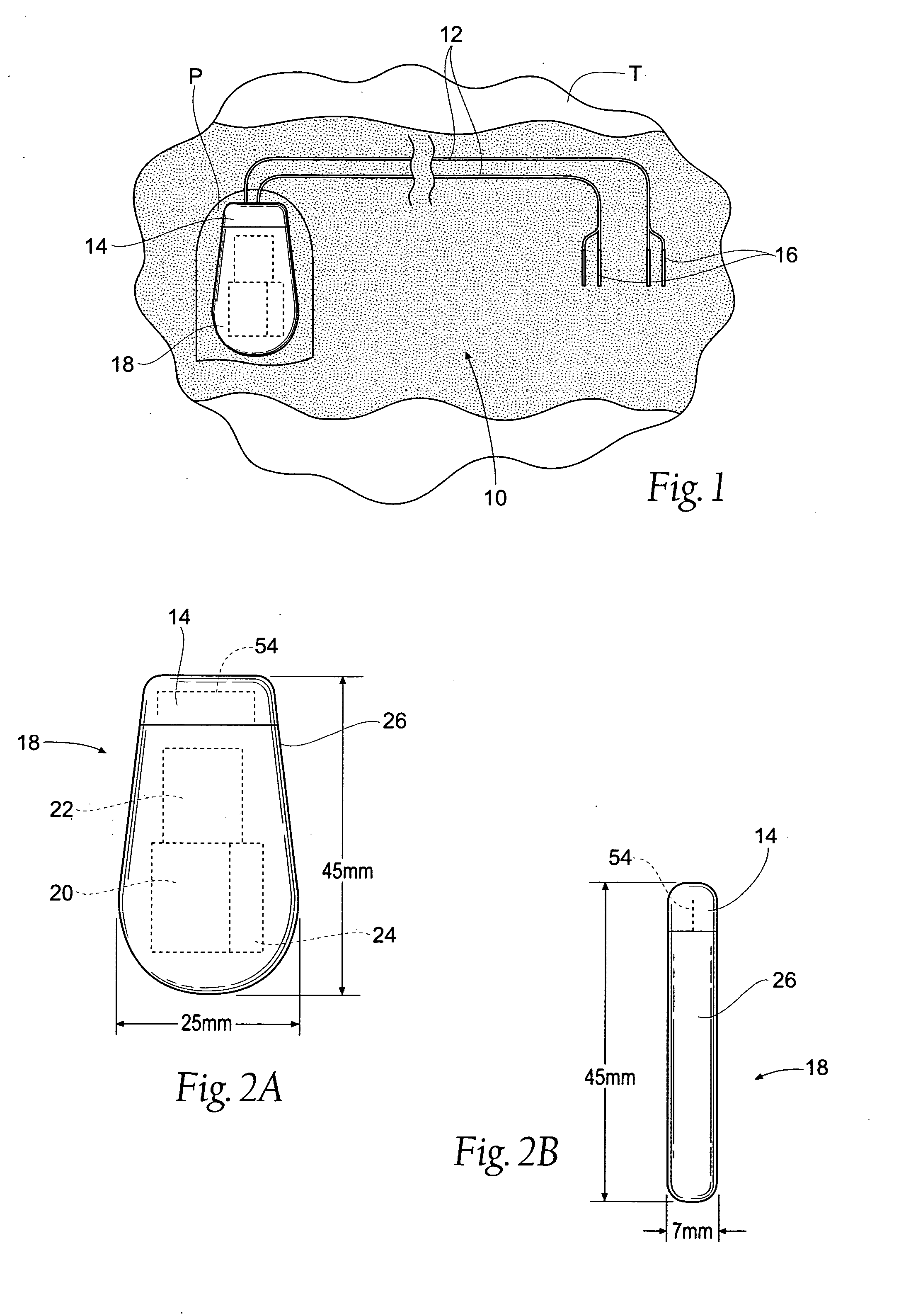 Implantable system and methods for acquisition and processing of electrical signals from muscles and/or nerves and/or central nervous system tissue