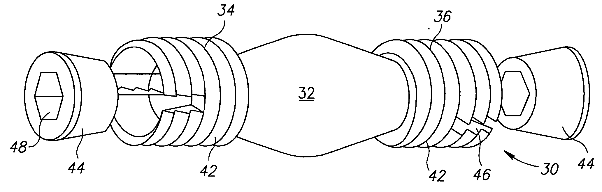 Facet prosthesis