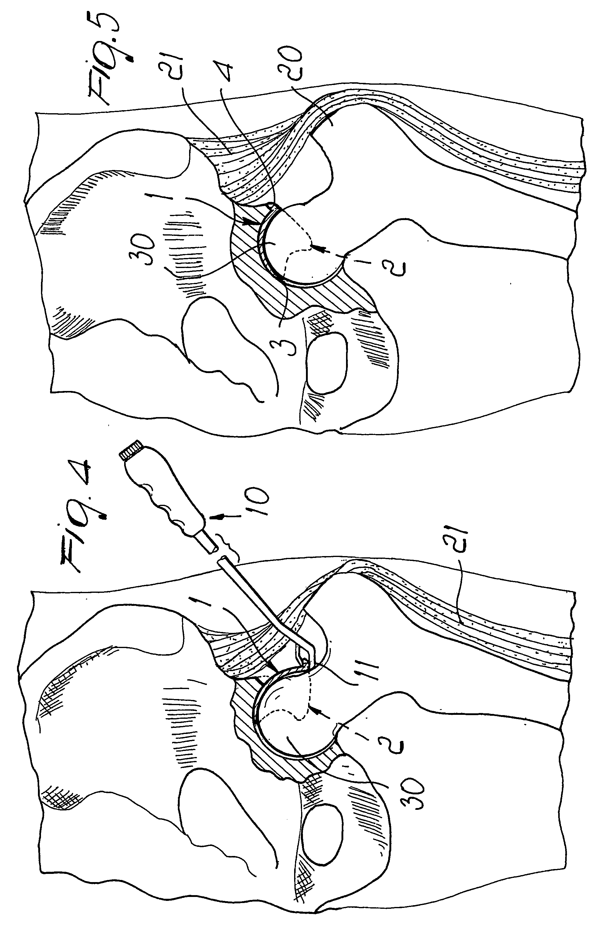 Corrective element for the articulation between the femur and the pelvis