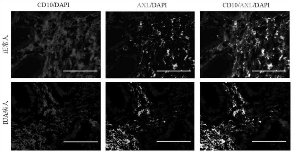 Application of AXL as diagnosis and treatment target of intrauterine adhesion