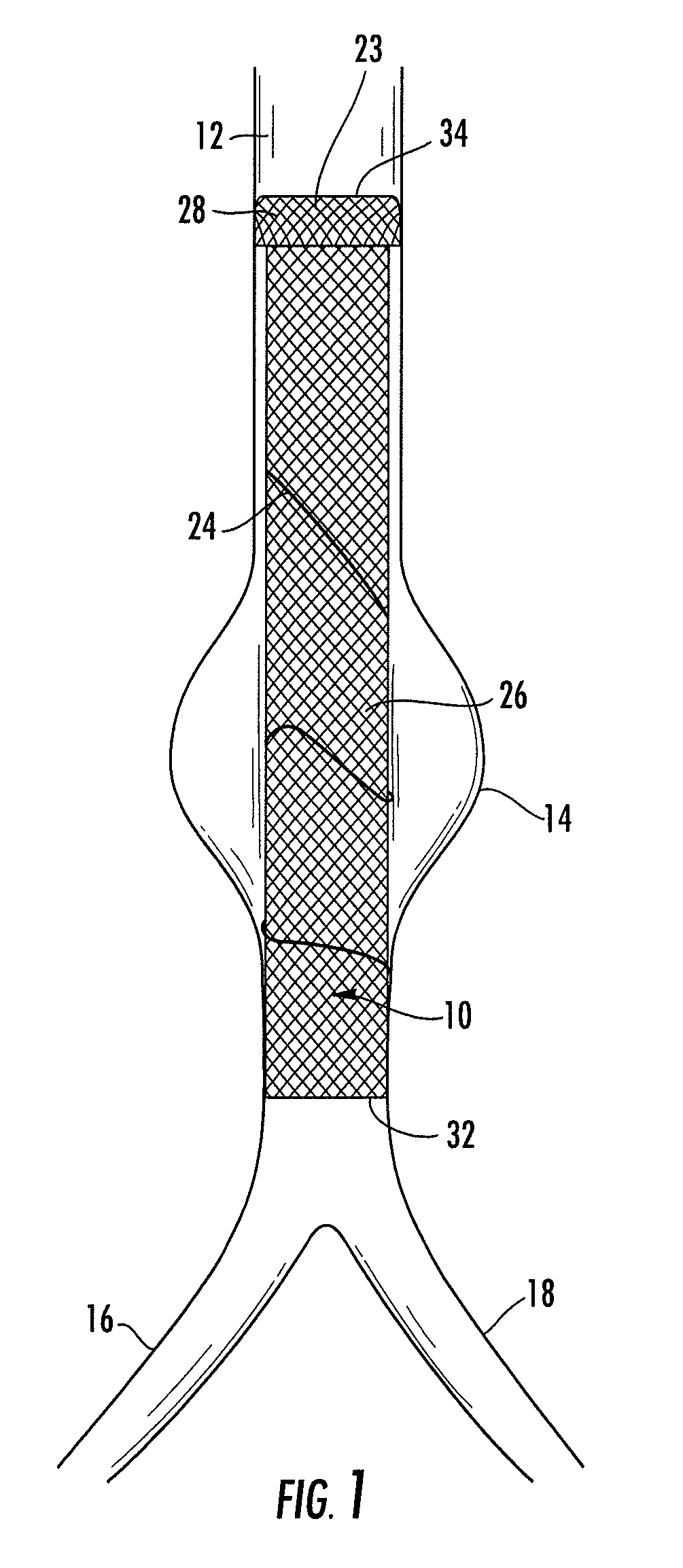 Stent graft for reinforcement of vascular abnormalities and associated method