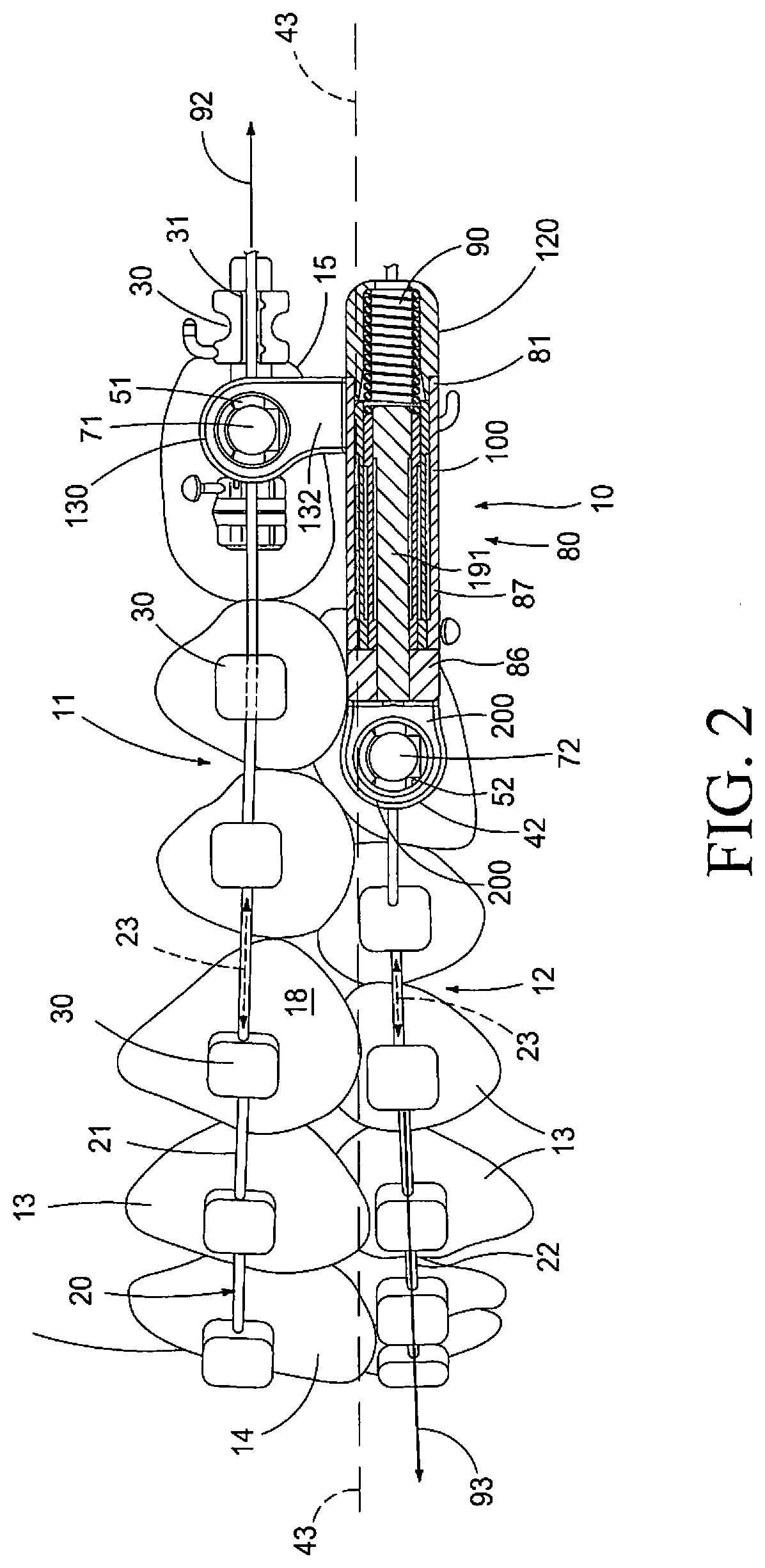 Method and Apparatus for Treating Malocclusions and Teeth Alignment