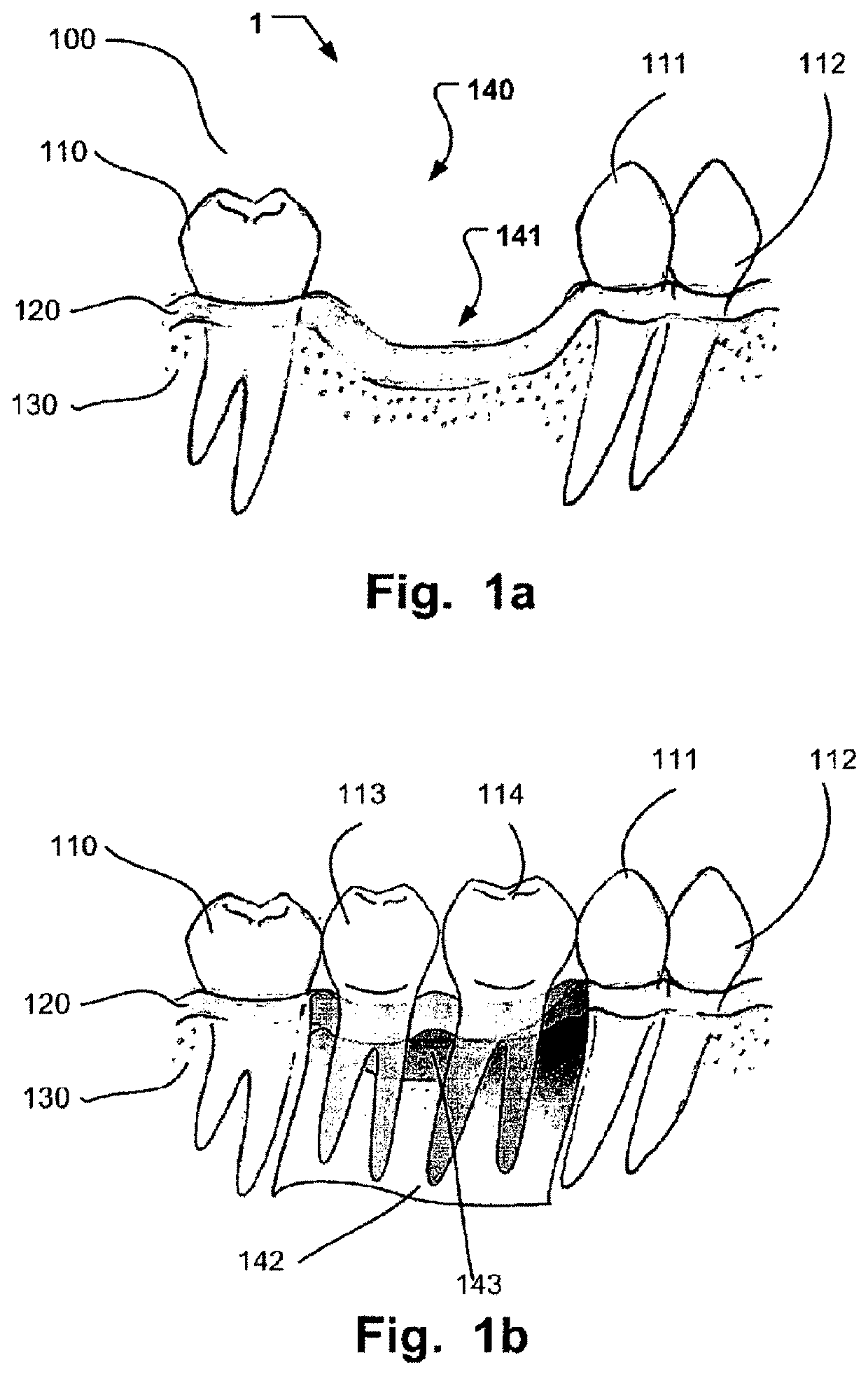 Computer implemented planning and providing of mass customized bone structure