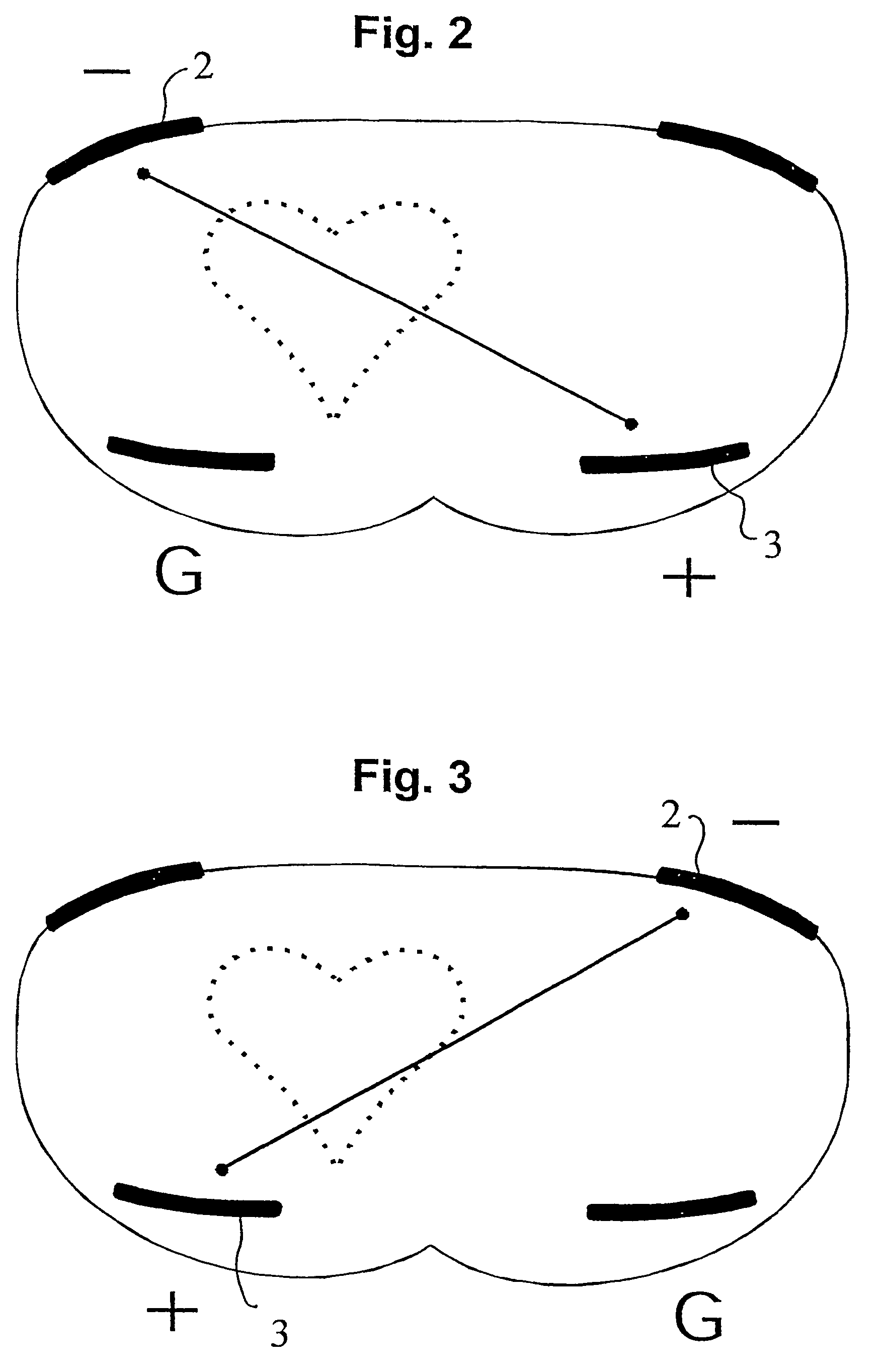 Method for recognizing the heartbeat and for calculating quantities acquired from the heartbeat