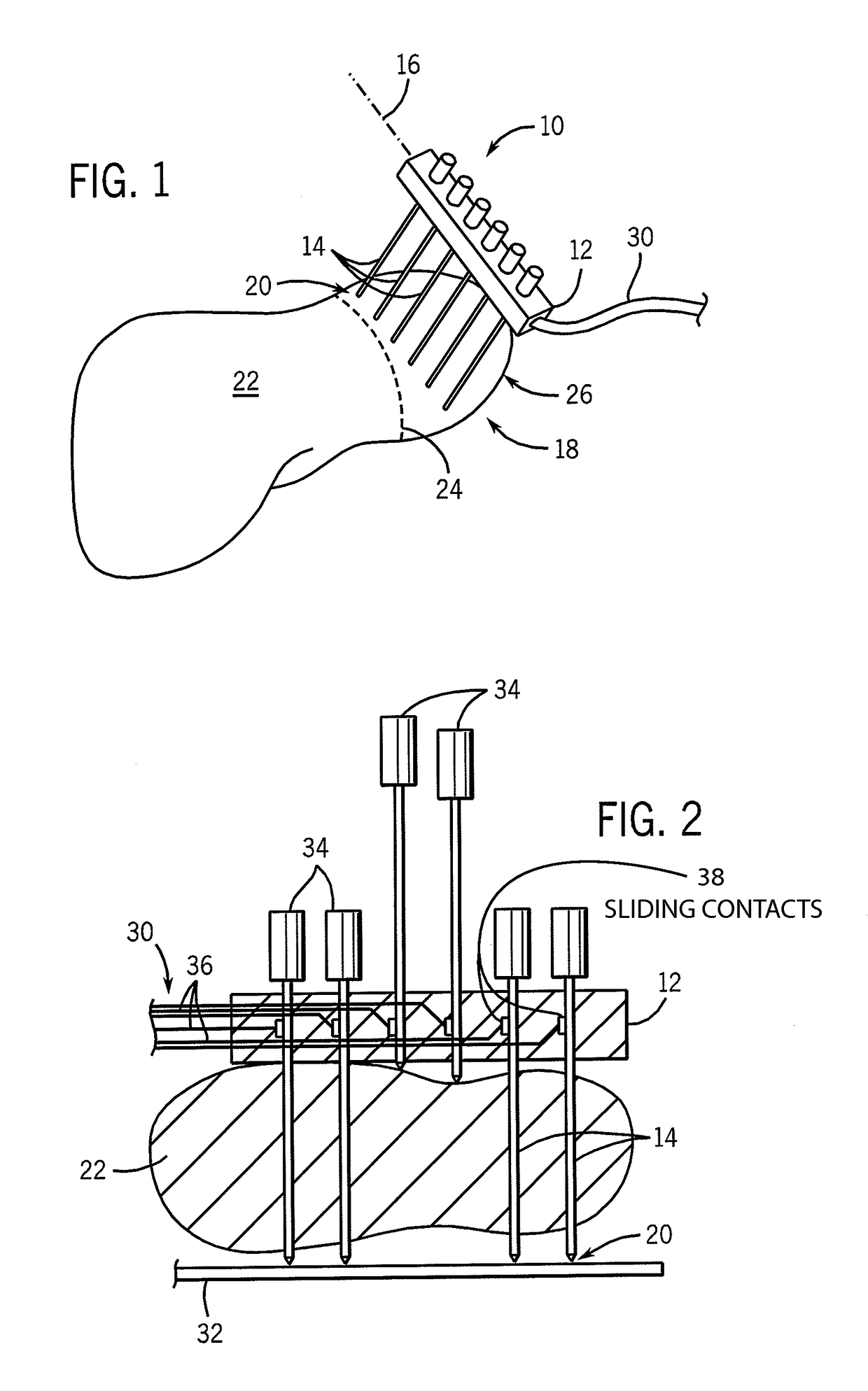 Circumferential electrode array for tissue ablation