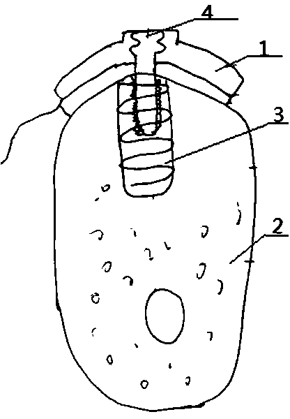 Dental implant gingival graft fixation guide plate, guide plate manufacturing method and fixation system