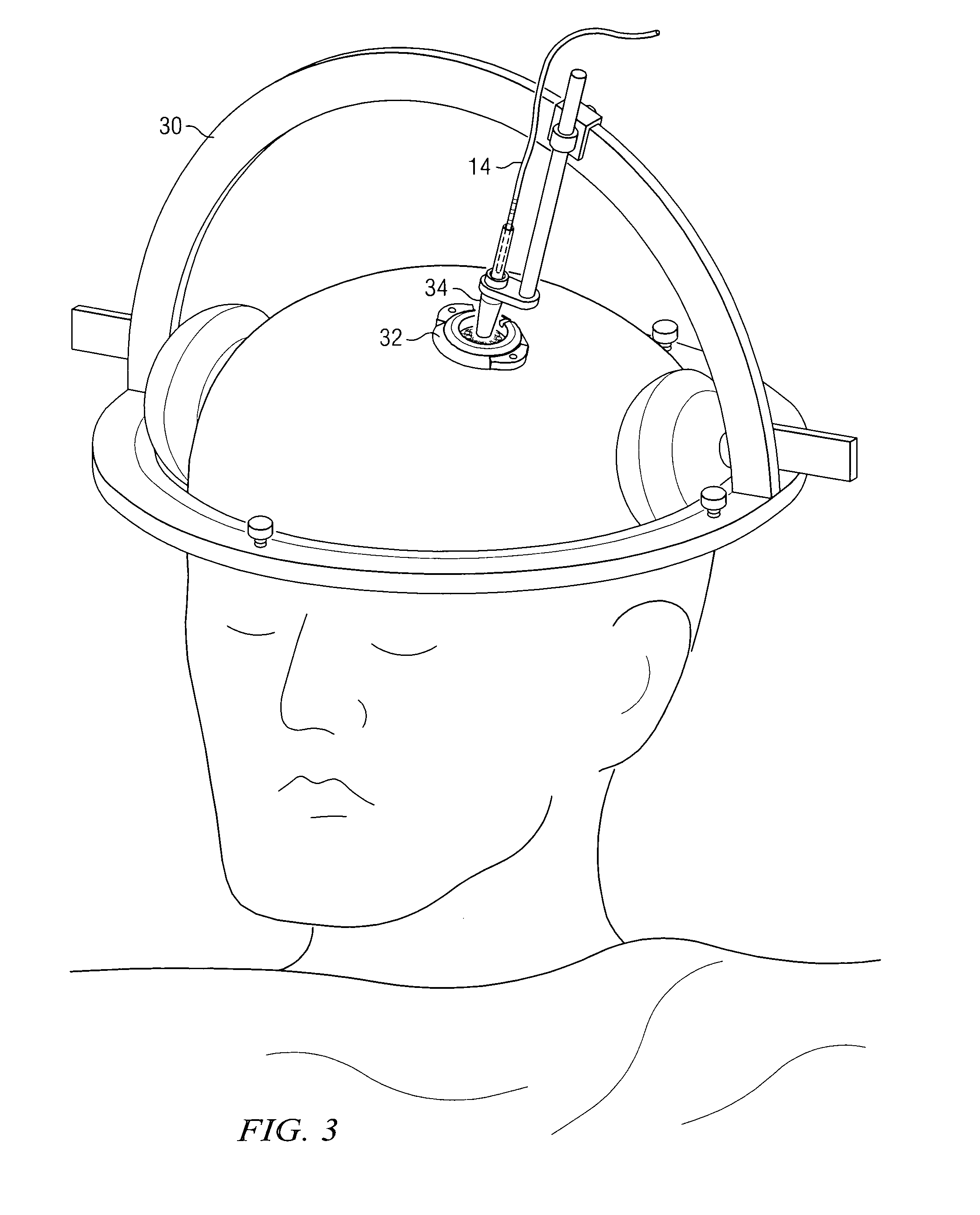 Electrical stimulation system and method for stimulating nerve tissue in the brain using a stimulation lead having a tip electrode, having at least five electrodes, or both