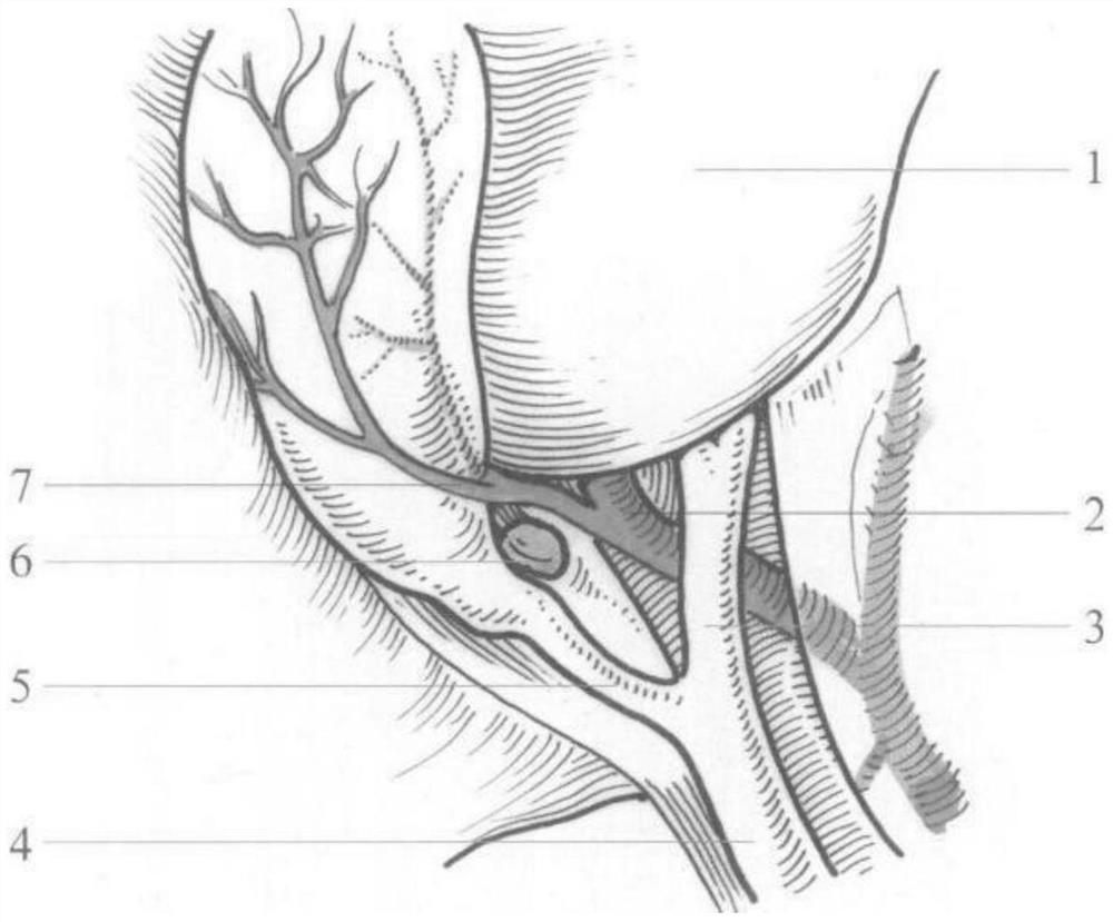 Laparoscopic cholecystectomy training device and method based on 3D printing technology