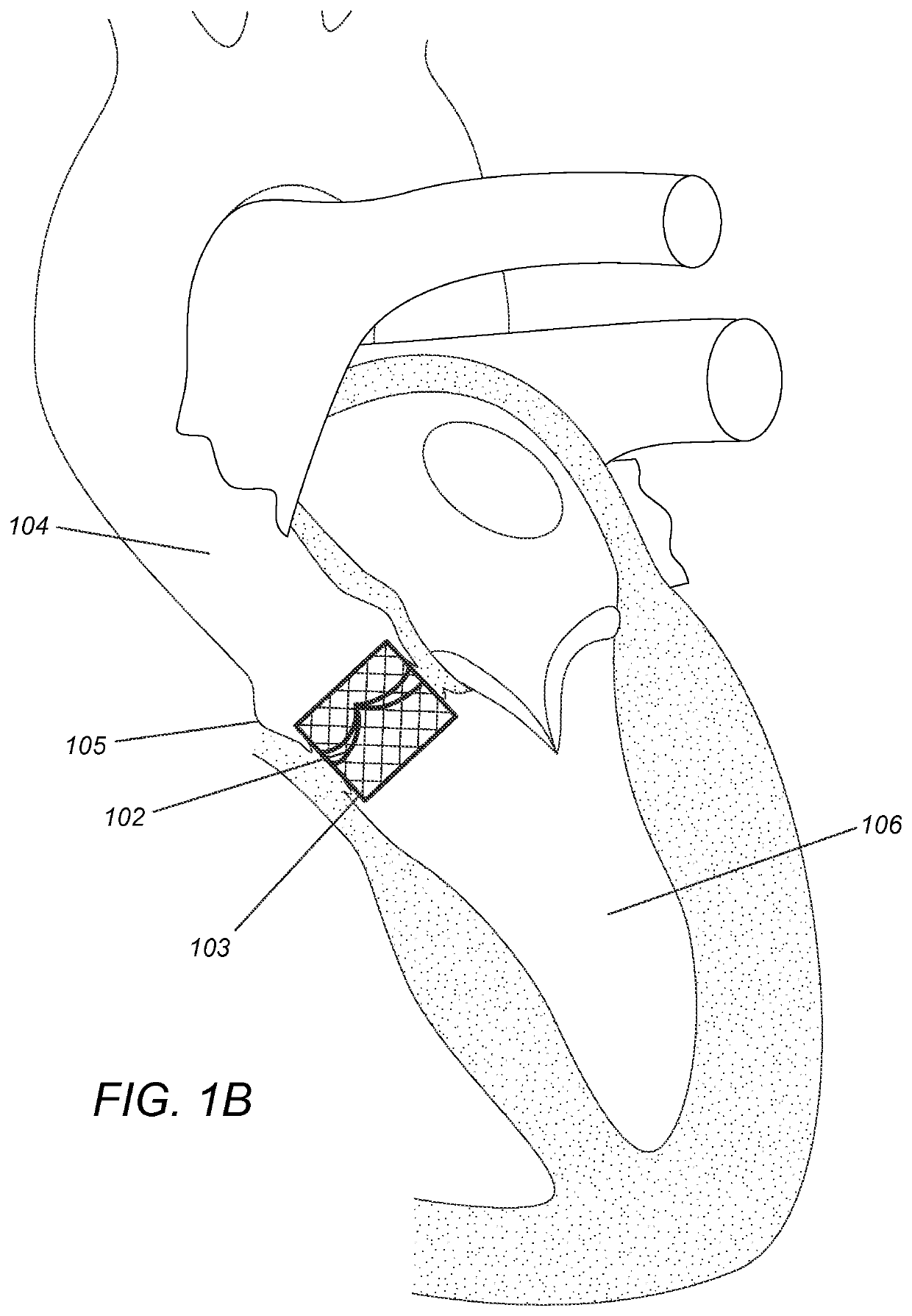 Modular dis-assembly of transcatheter valve replacement devices and uses thereof